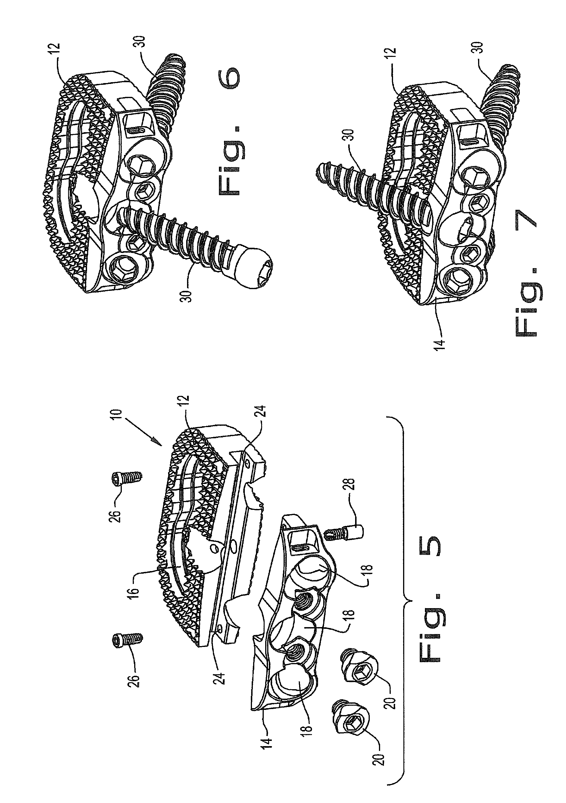 Intervertebral fusion implant