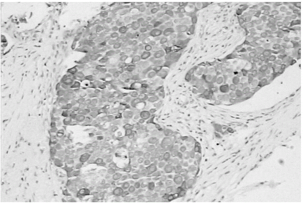 A tumor marker and combined detection method thereof in blood