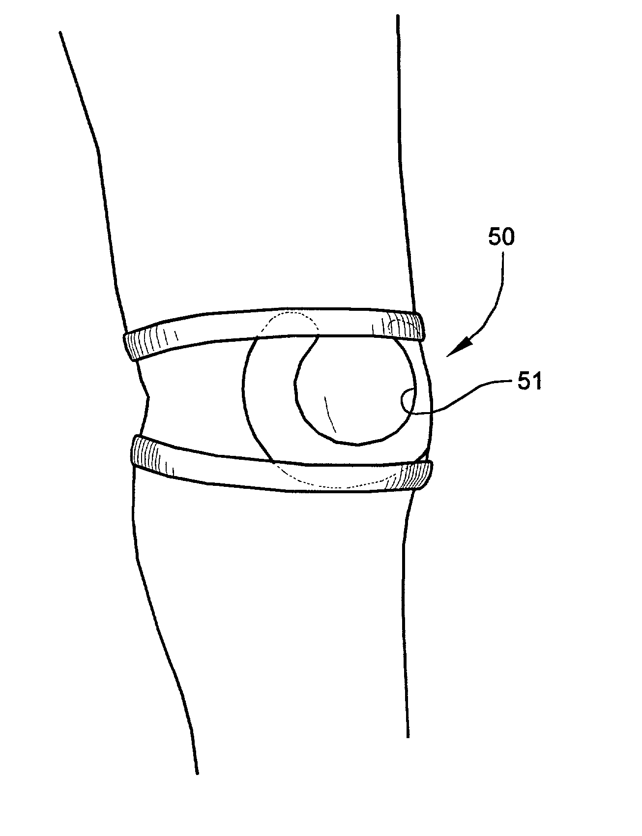 Custom-moldable patellar support, support product for improved patella tracking, and method