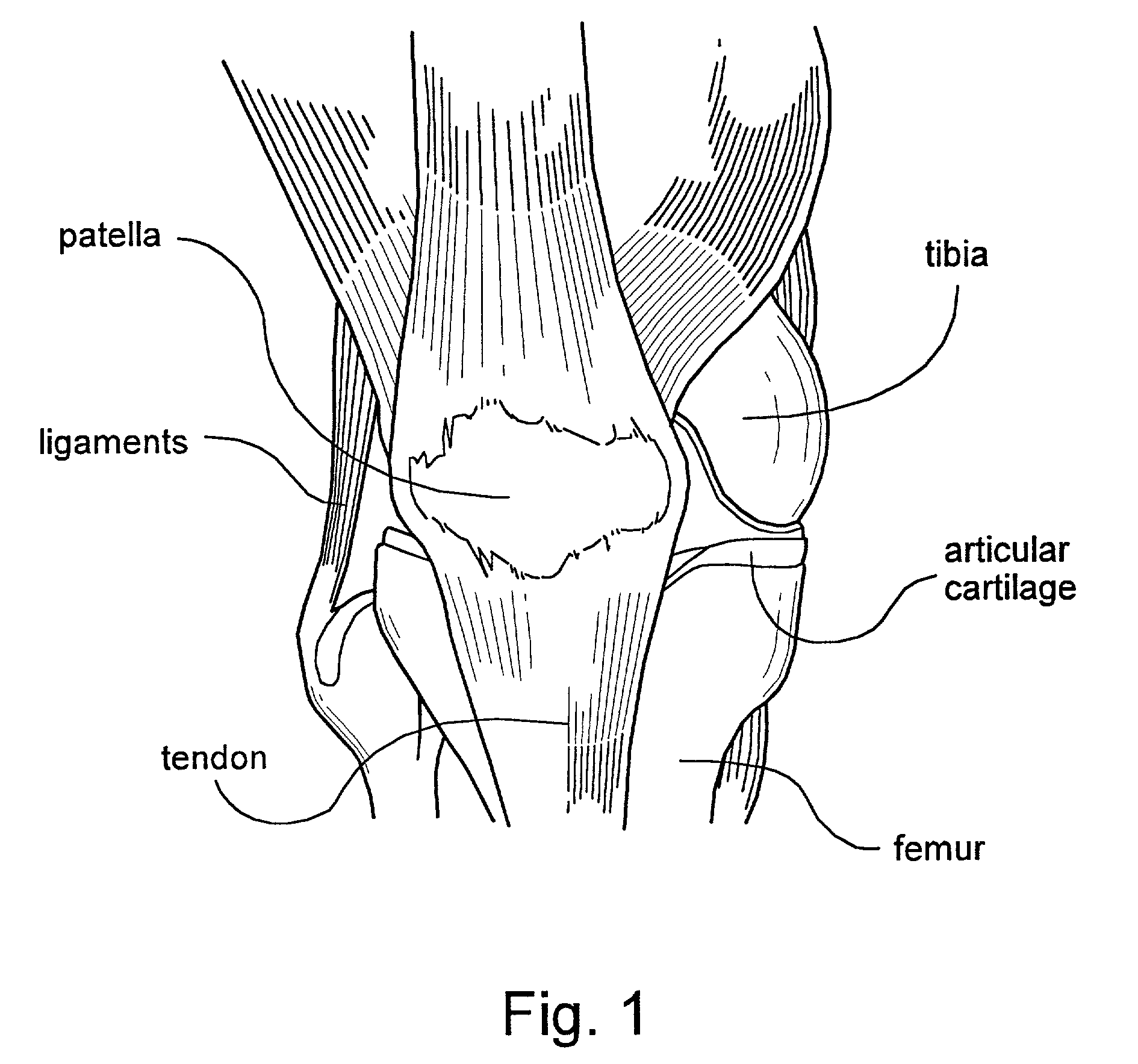 Custom-moldable patellar support, support product for improved patella tracking, and method