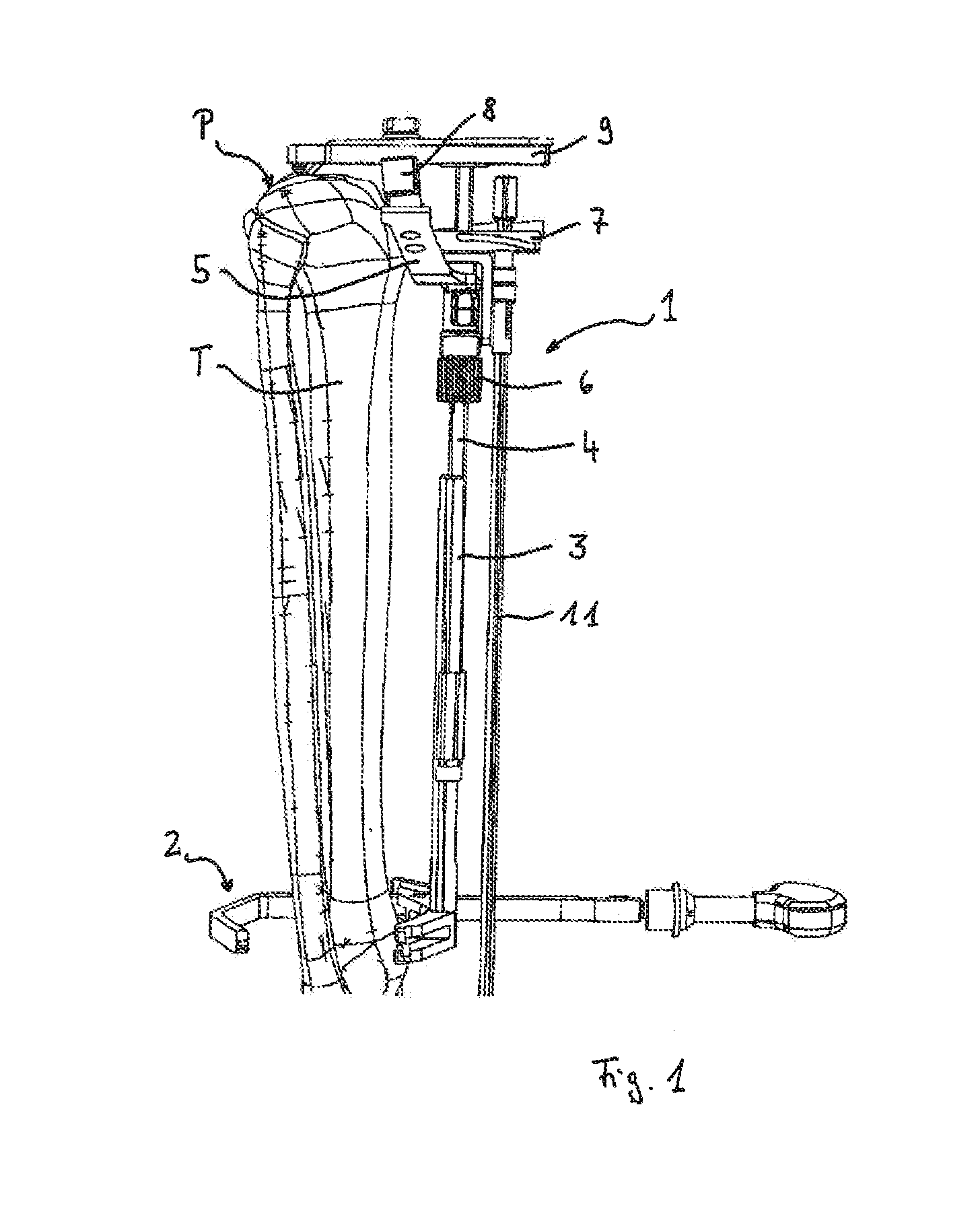 Device for defining a cutting plane for a bone resection