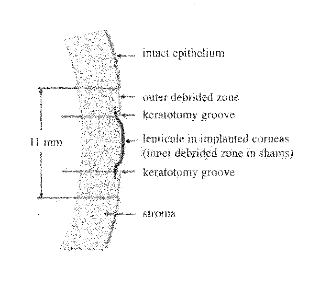 Artificial corneal implant