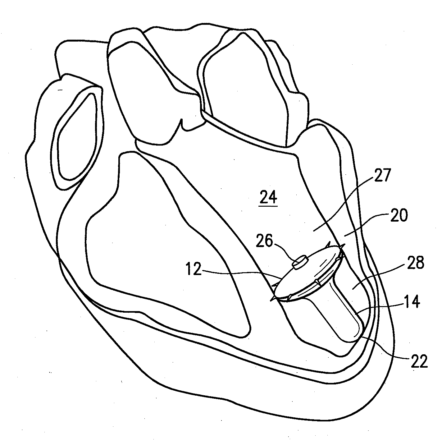 Inflatable ventricular partitioning device