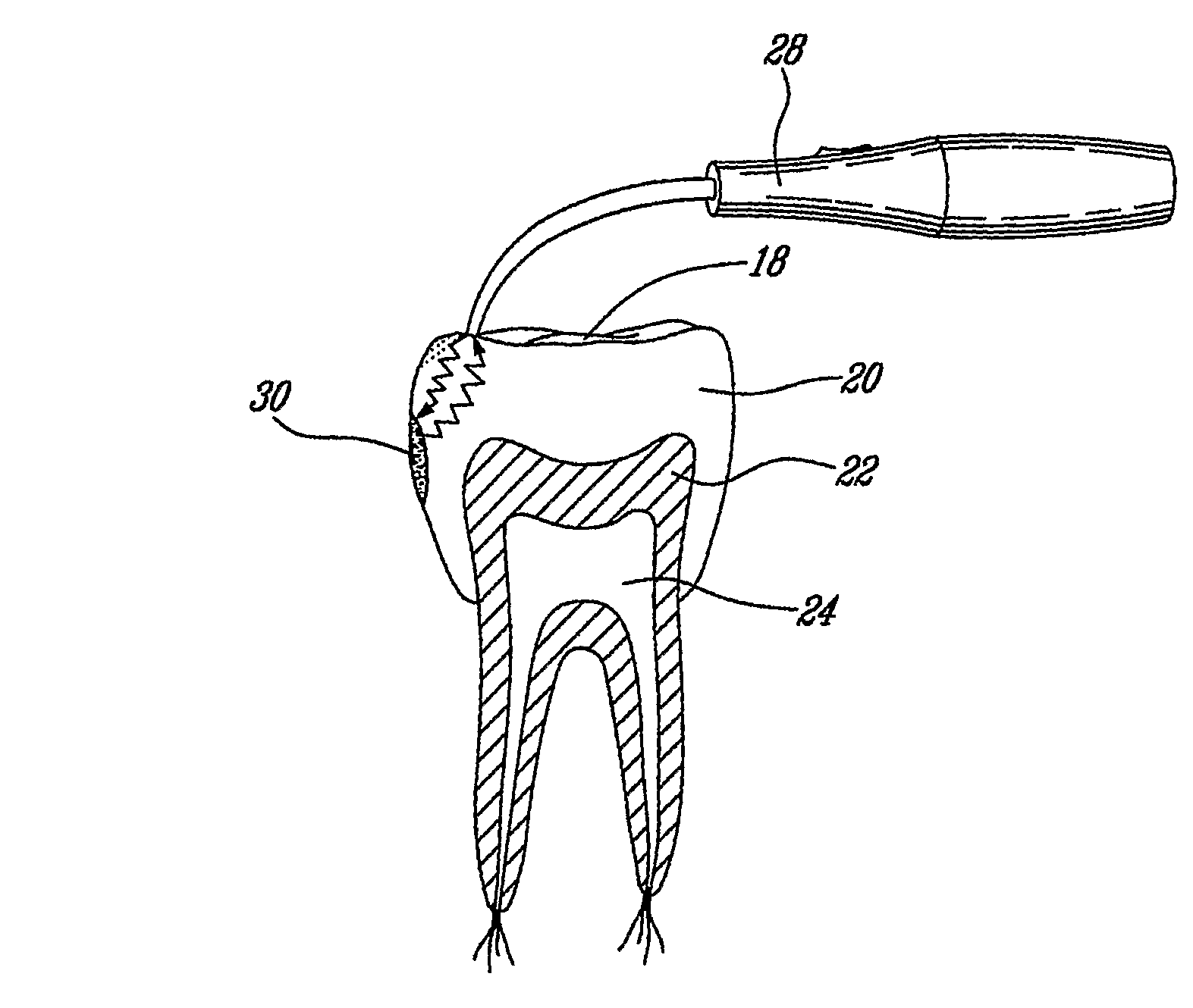 Interproximal tooth defects detection