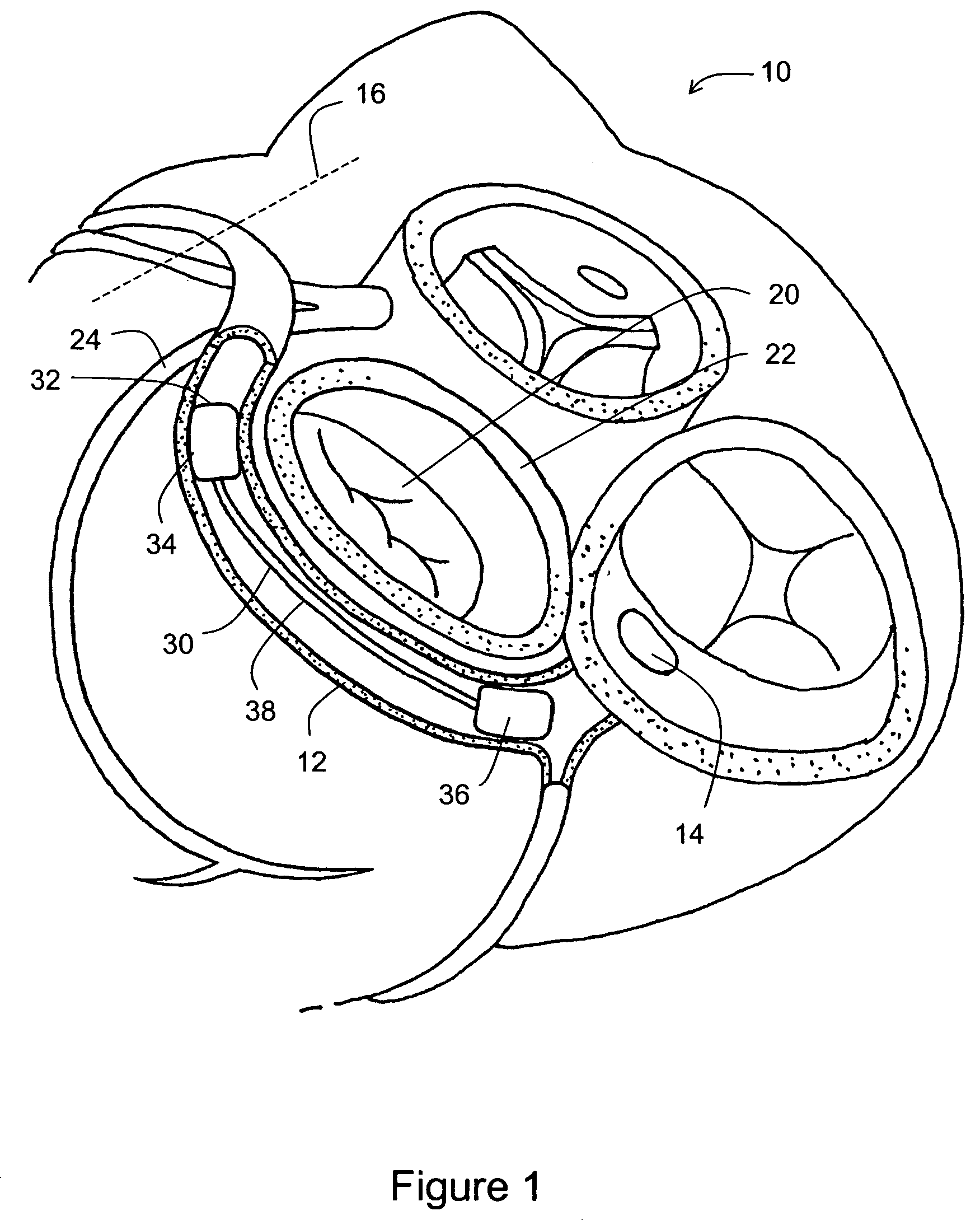 Reduced length tissue shaping device