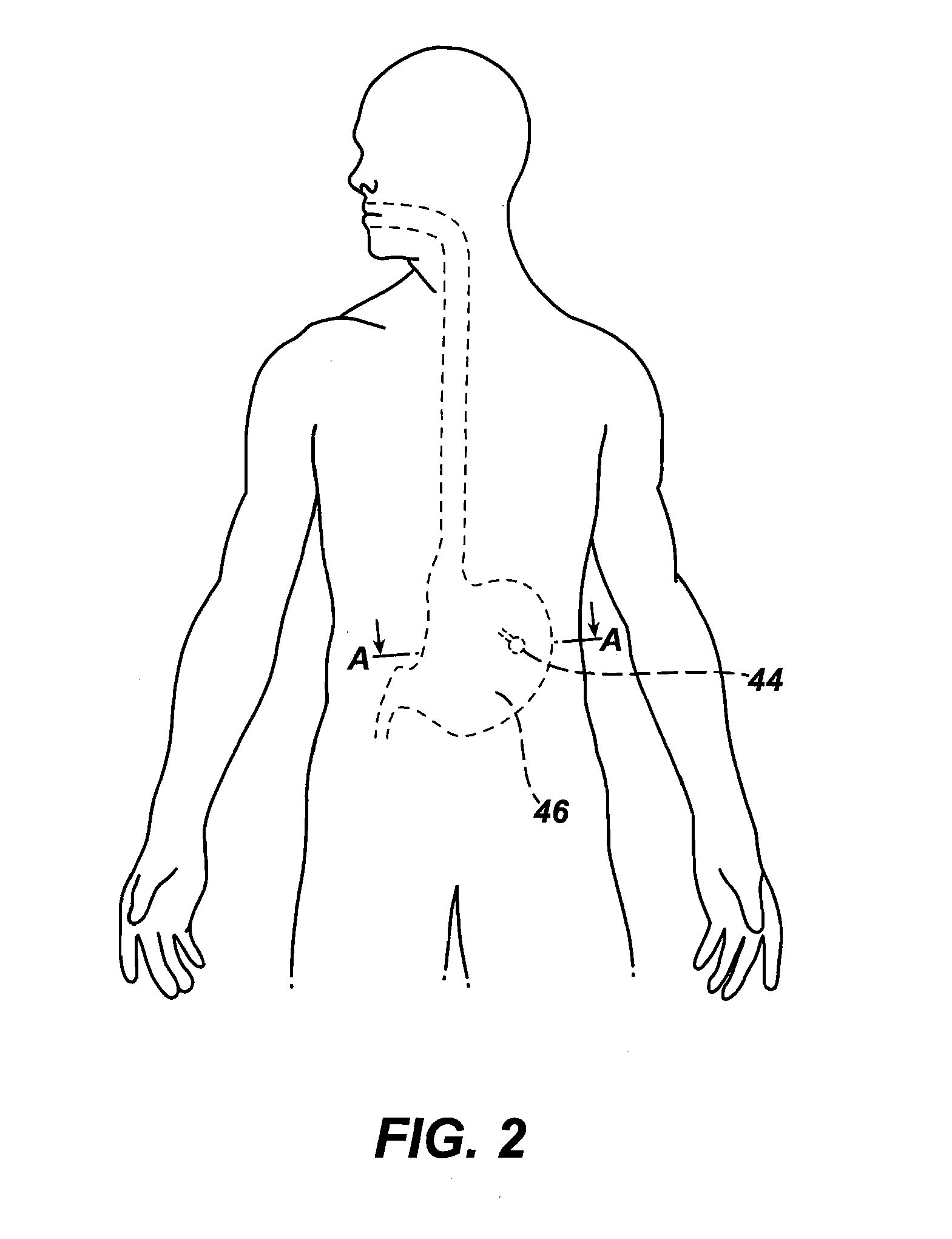 Method of remotely adjusting a satiation and satiety-inducing implanted device