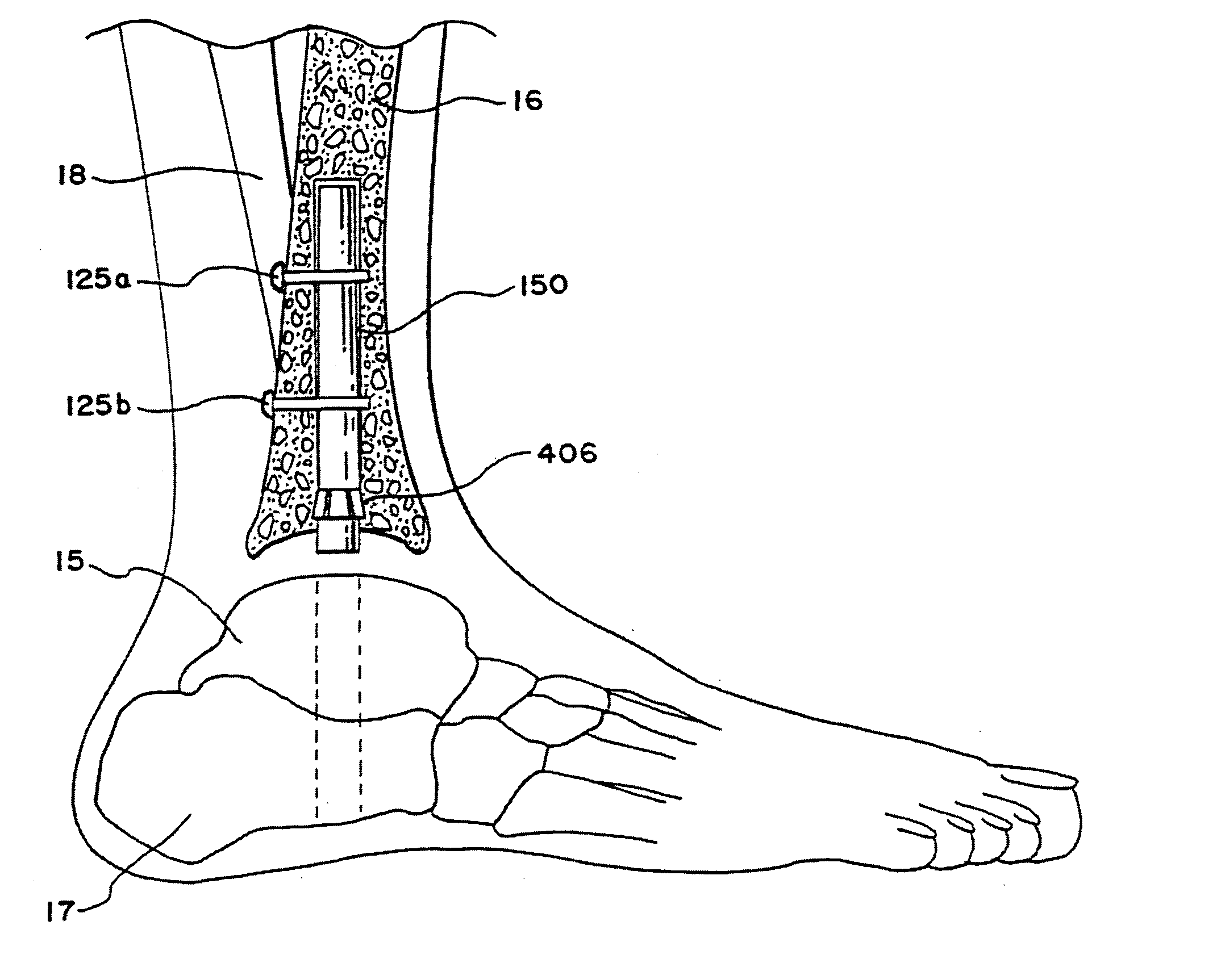 Intramedullary guidance systems and methods for installing ankle replacement prostheses