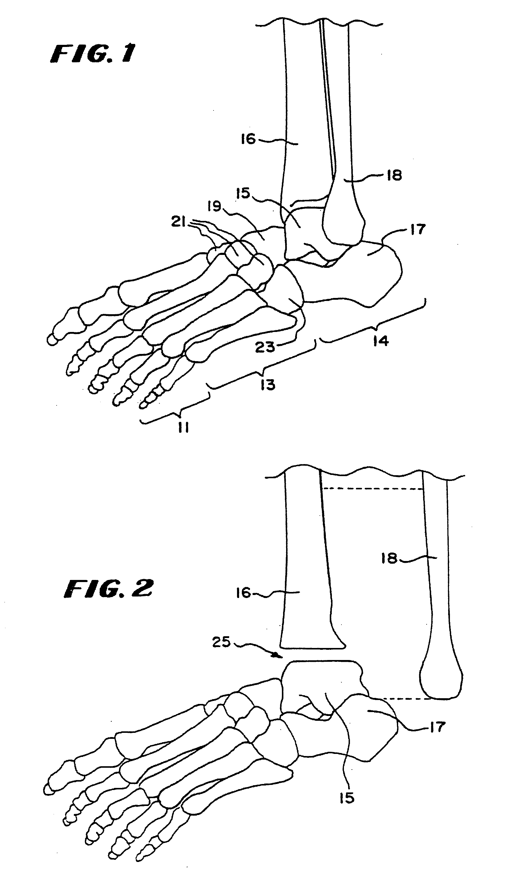 Intramedullary guidance systems and methods for installing ankle replacement prostheses