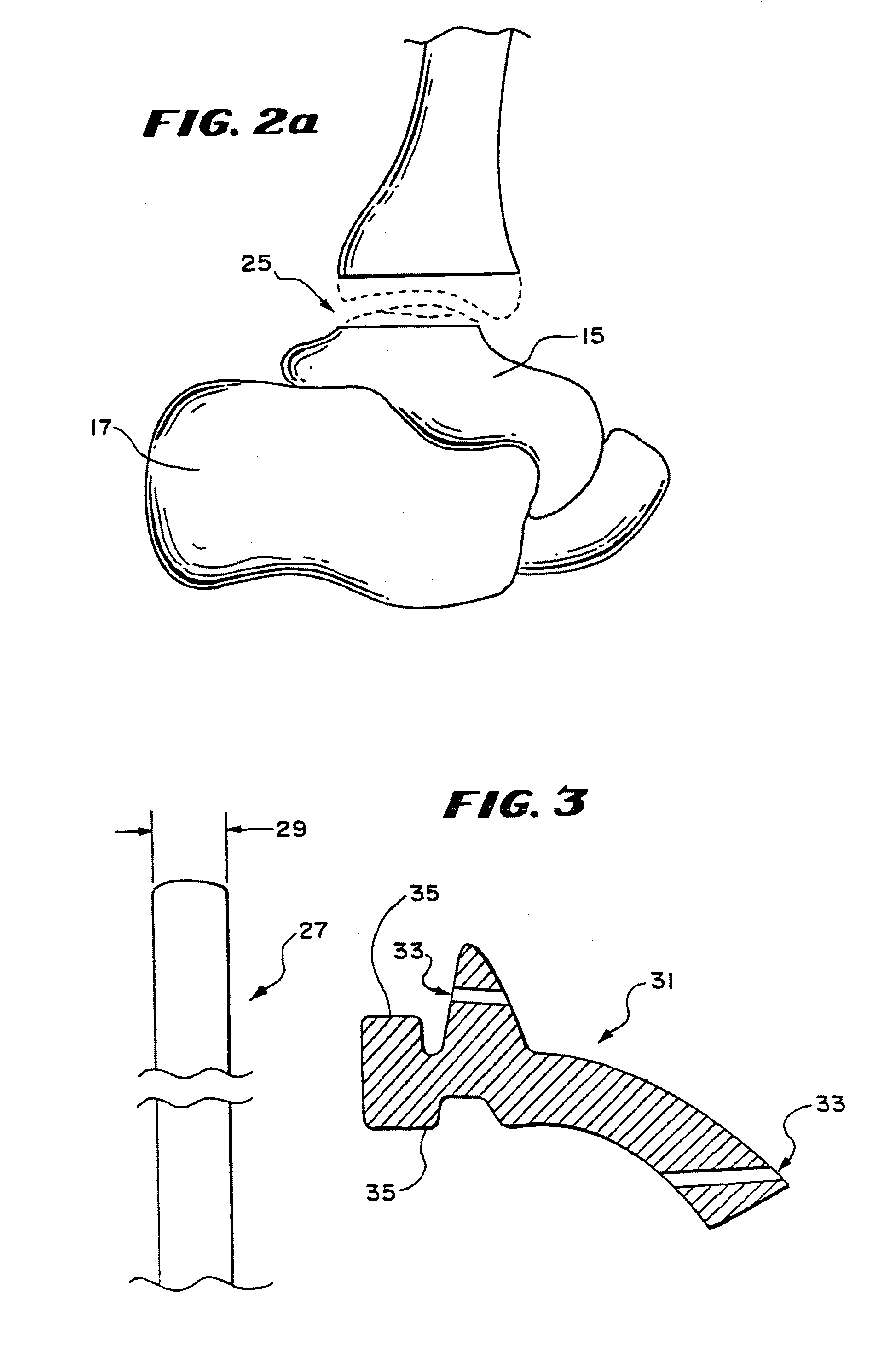 Intramedullary guidance systems and methods for installing ankle replacement prostheses