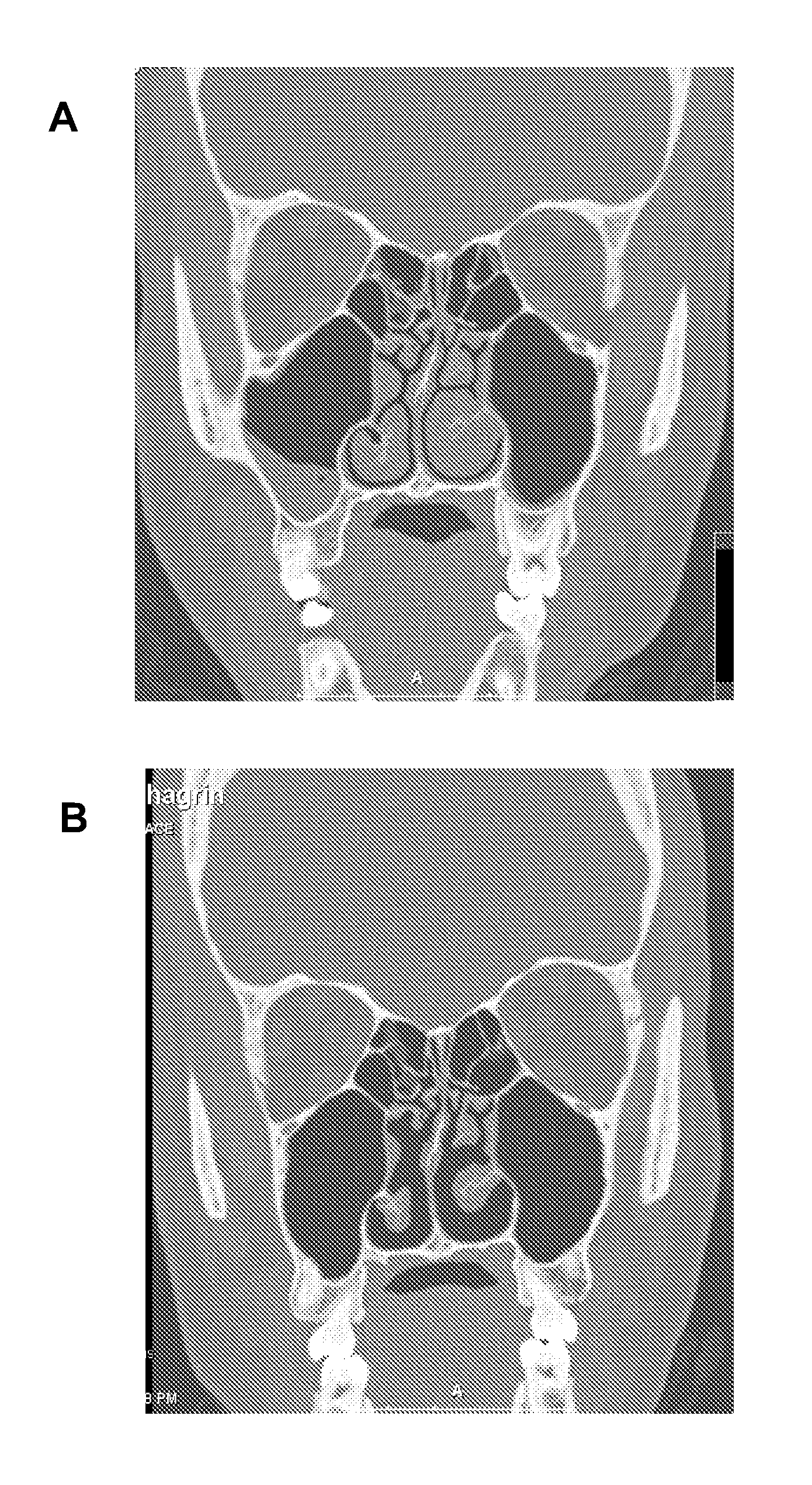 Nasal spray composition and method for treating rhinitis, sinusitis or both