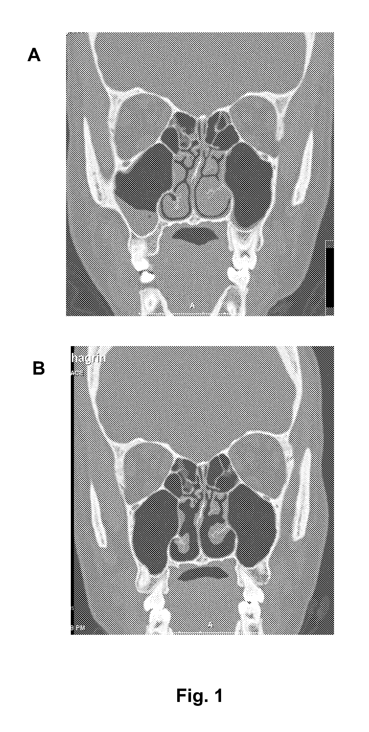 Nasal spray composition and method for treating rhinitis, sinusitis or both