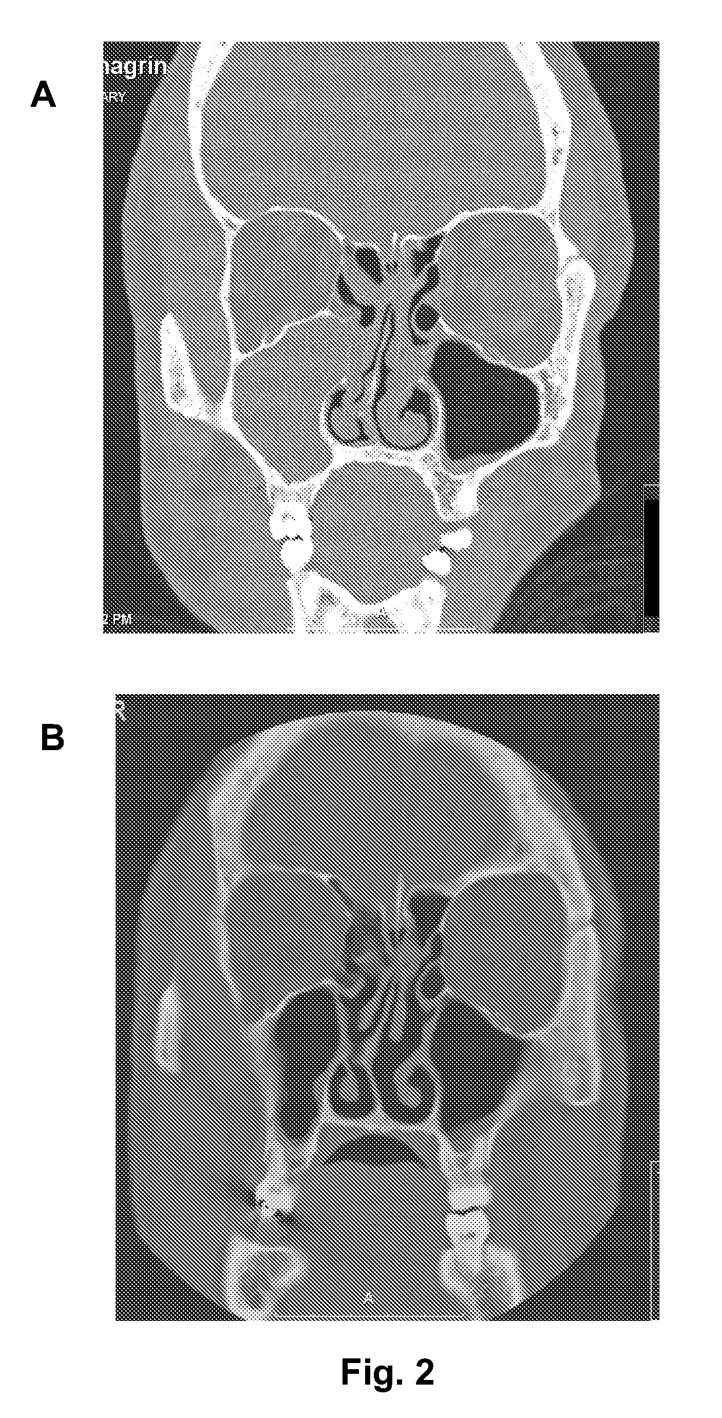 Nasal spray composition and method for treating rhinitis, sinusitis or both