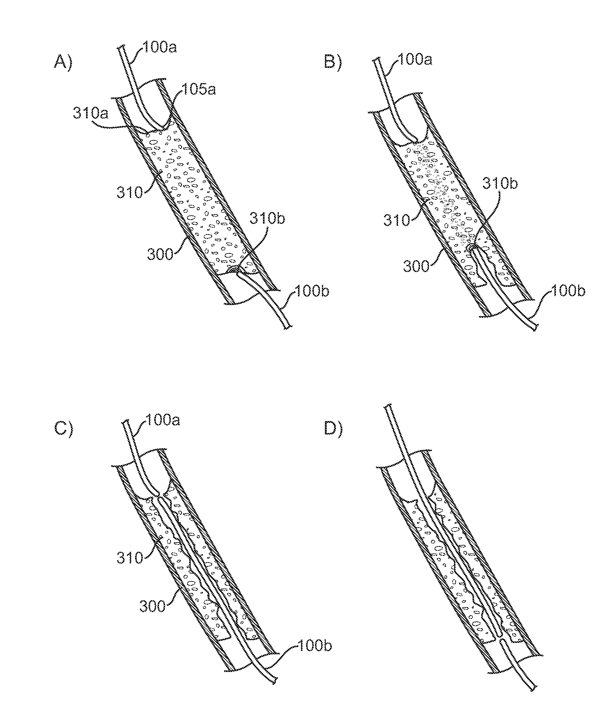 Recanalizing occluded vessels using radiofrequency energy