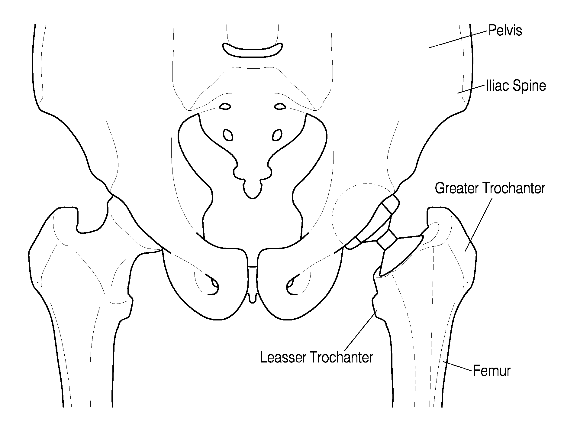 Hip surgery systems and methods