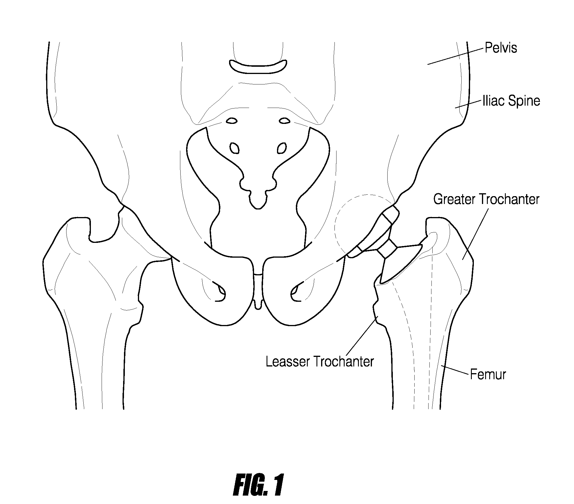 Hip surgery systems and methods