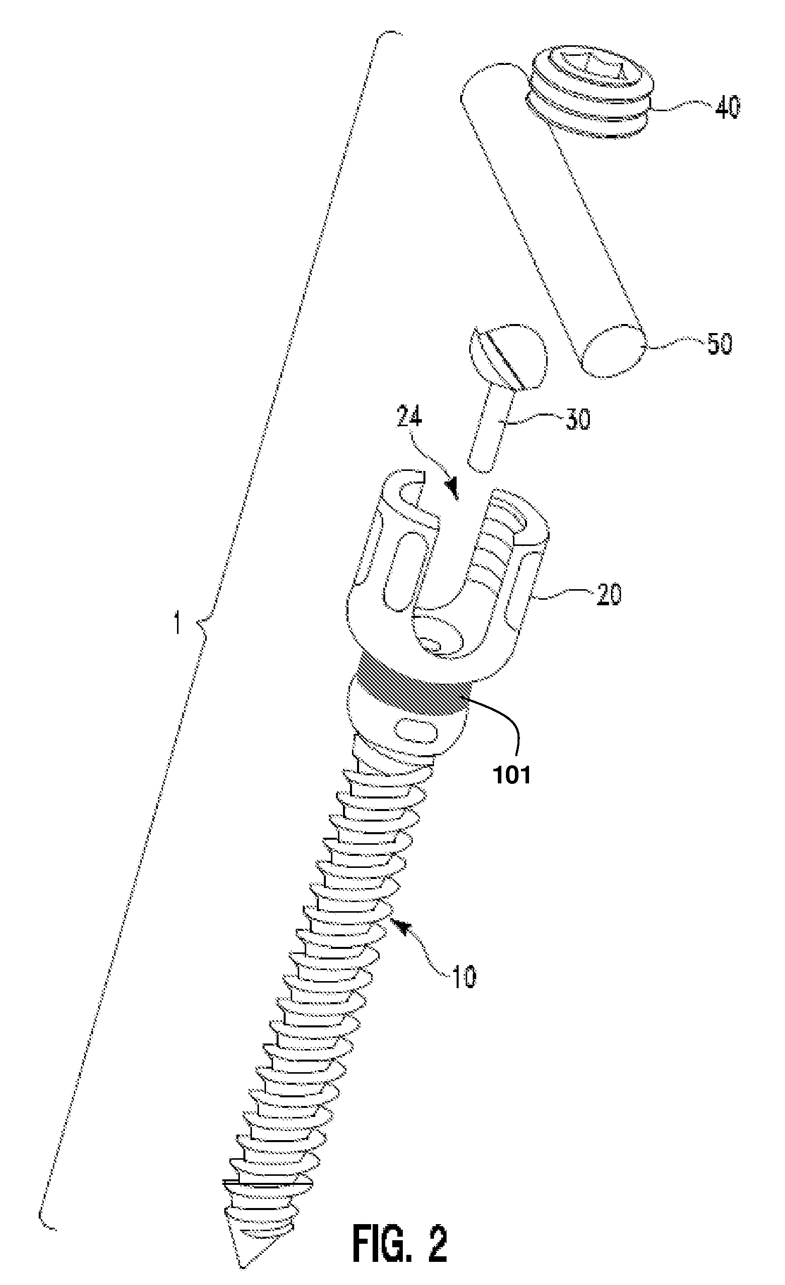 Spring-loaded, load sharing polyaxial pedicle screw assembly and method