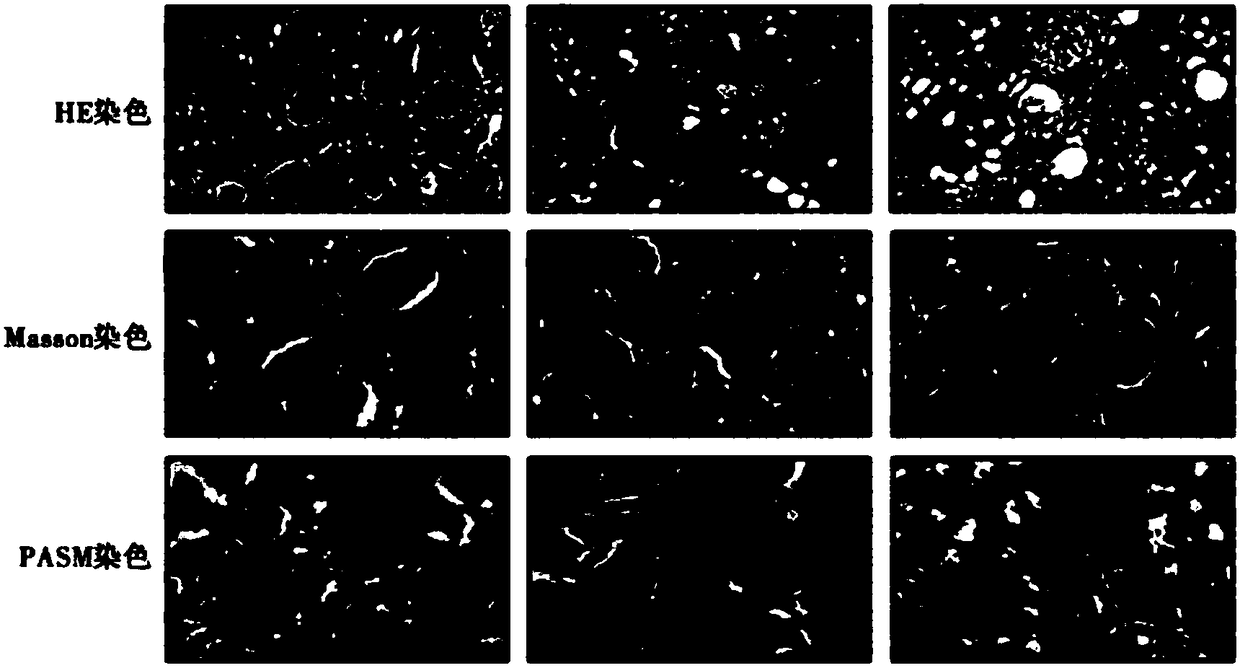 Application of sinomenine hydrochloride in promoting apoptosis of mesangial cells