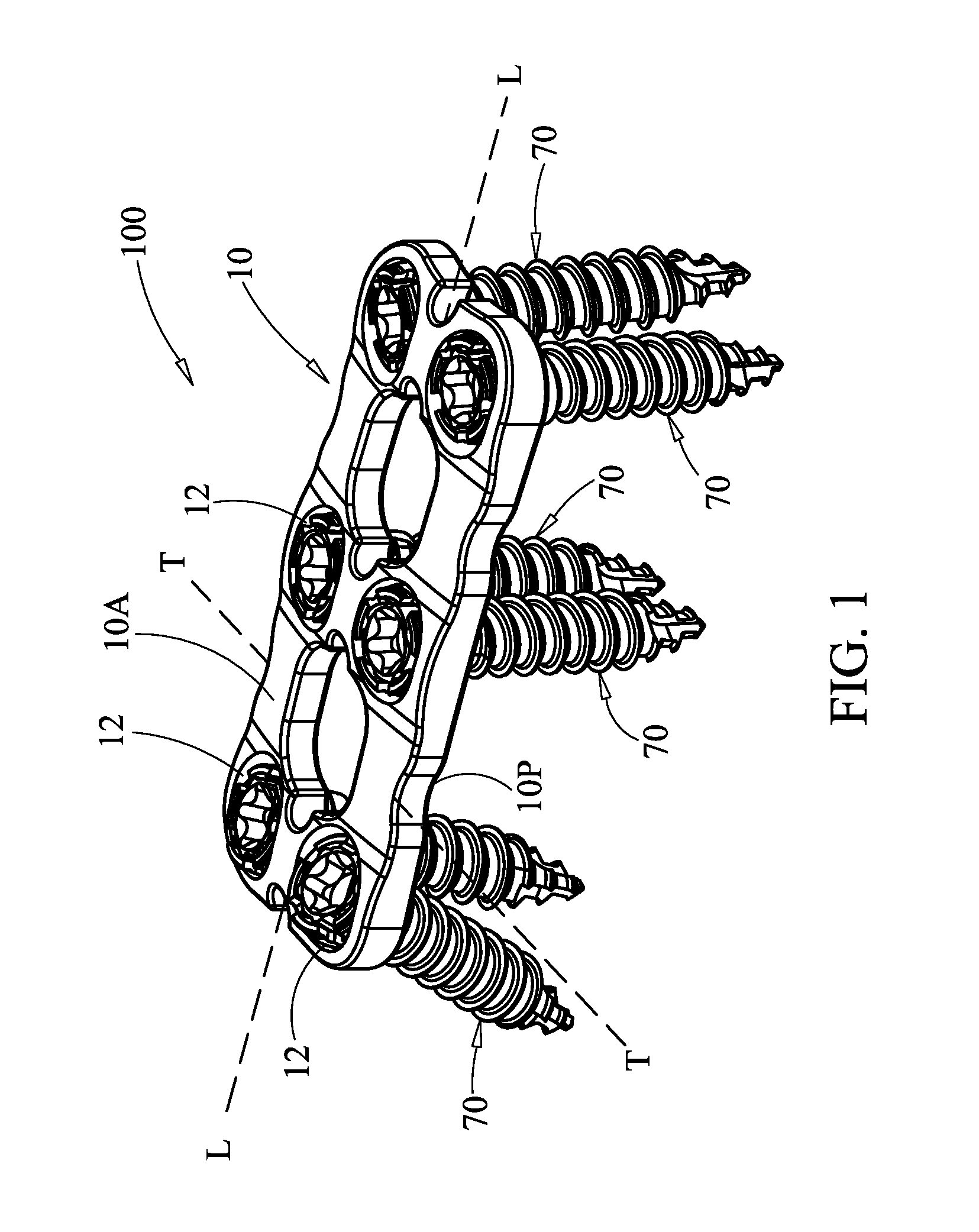 Surgical plate system and method