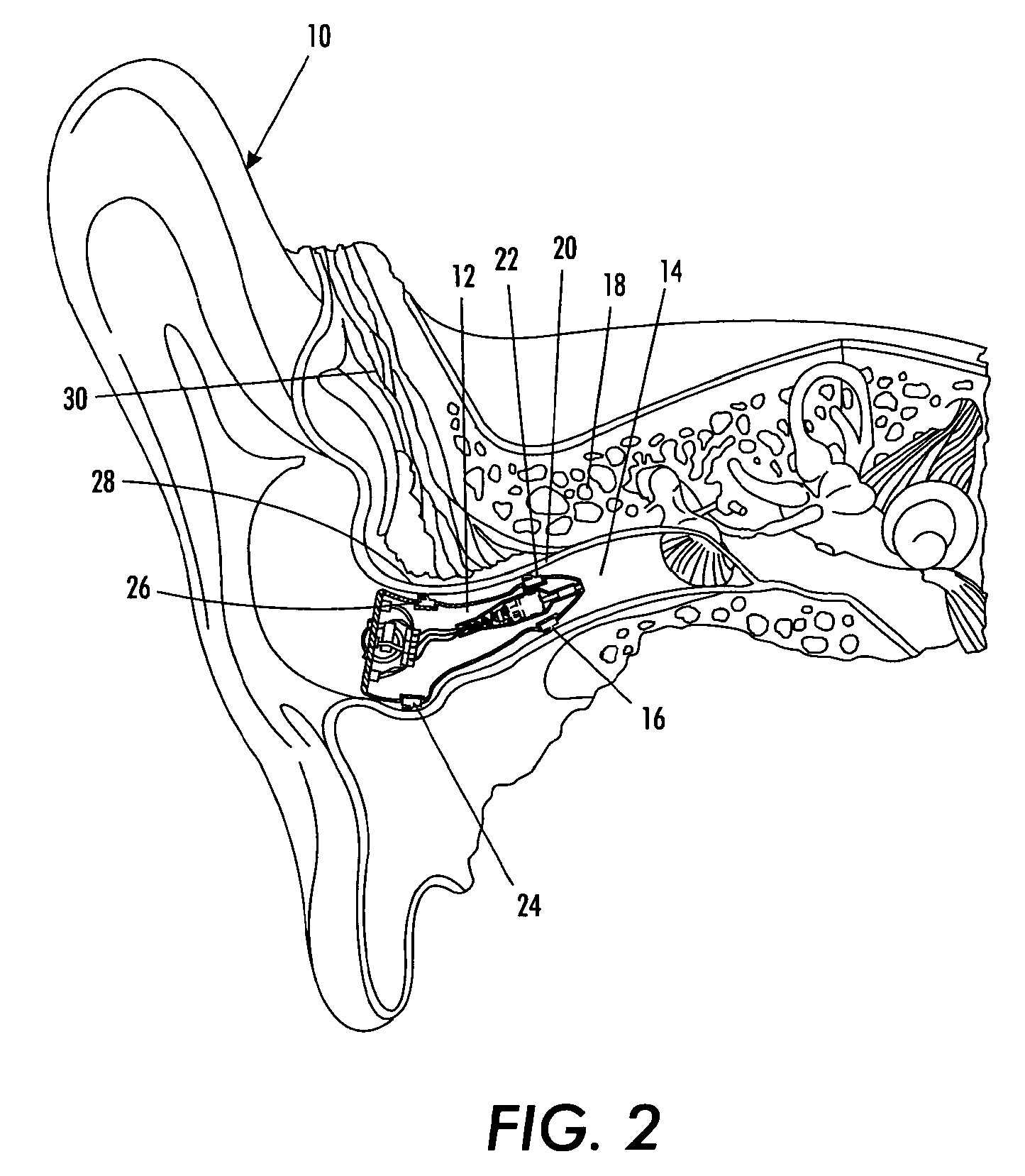 In the ear hearing aid utilizing annular acoustic seals