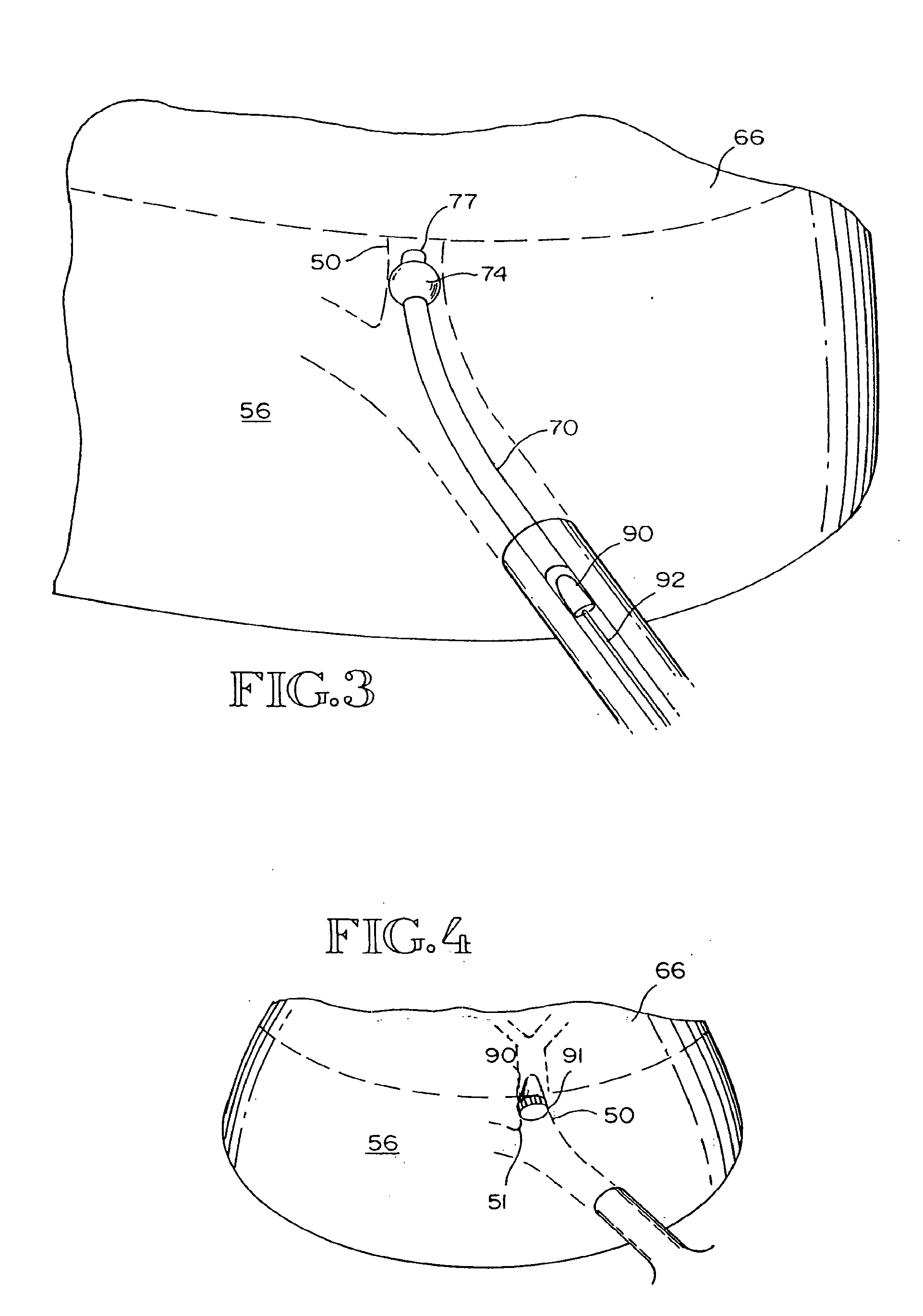 Removable anchored lung volume reduction devices and methods