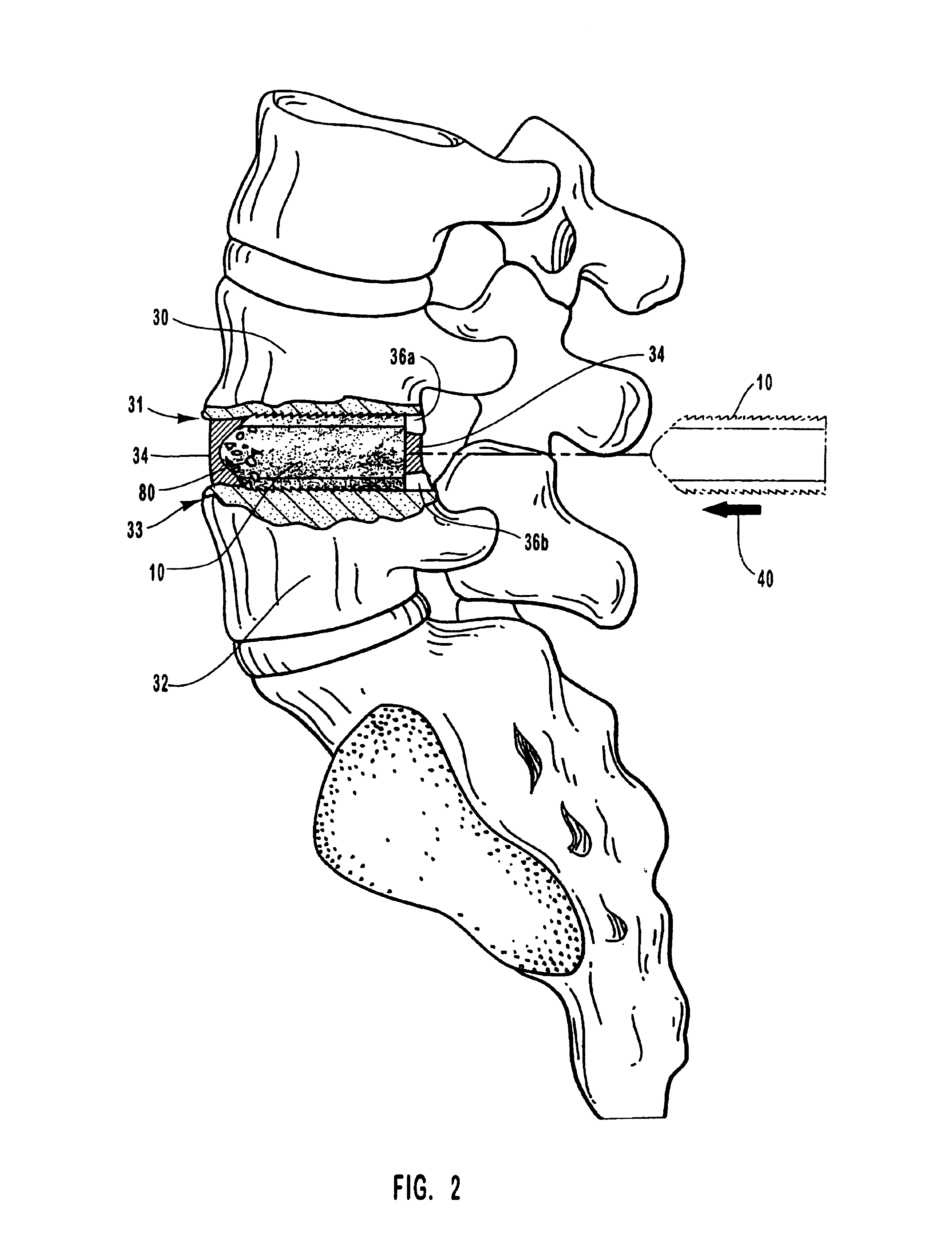 Spinal vertebral implant and methods of insertion