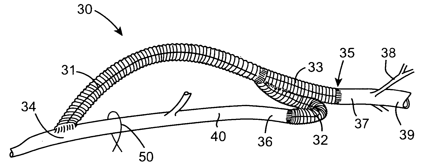 Vascular graft