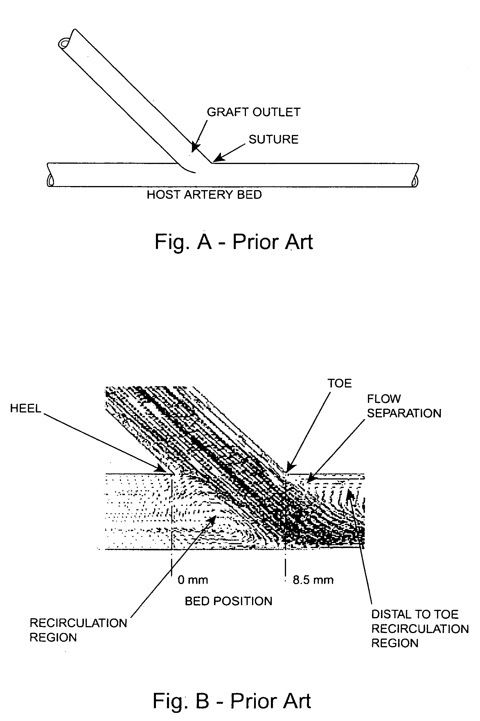 Vascular graft