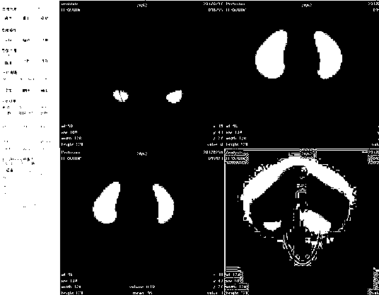 Quantitative analysis software for pulmonary perfusion and ventilation tomography