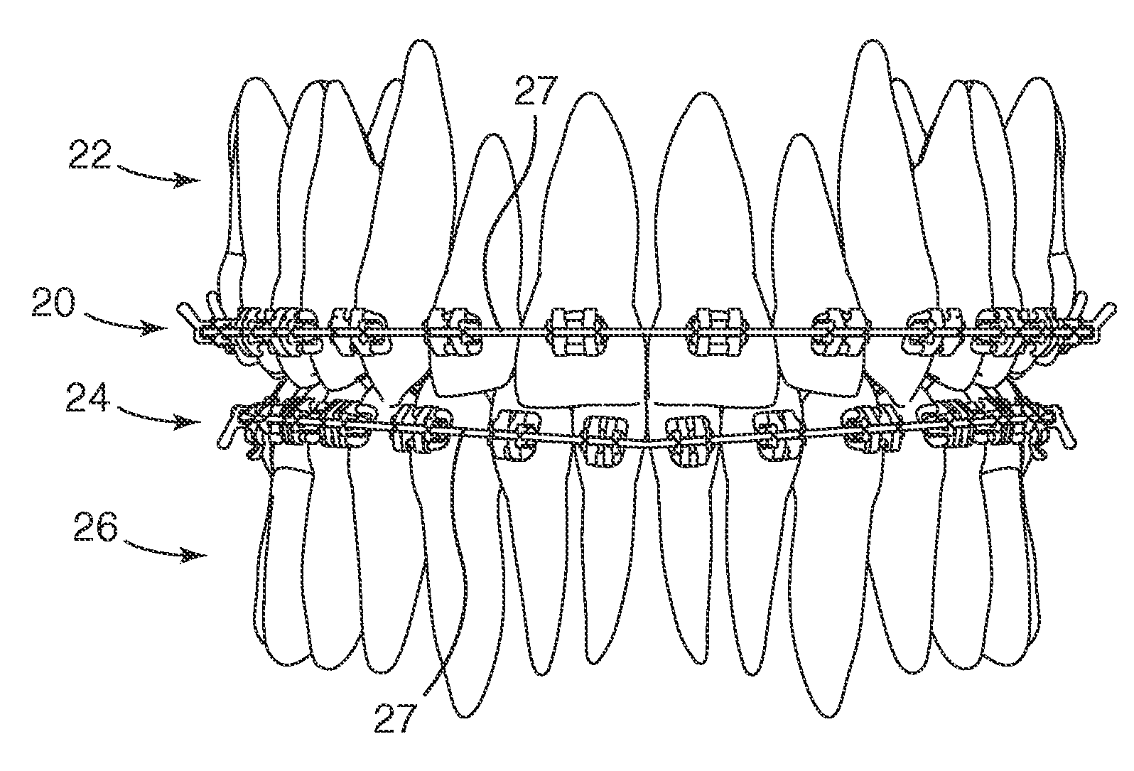 Orthodontic brace with coordinated bracket profiles