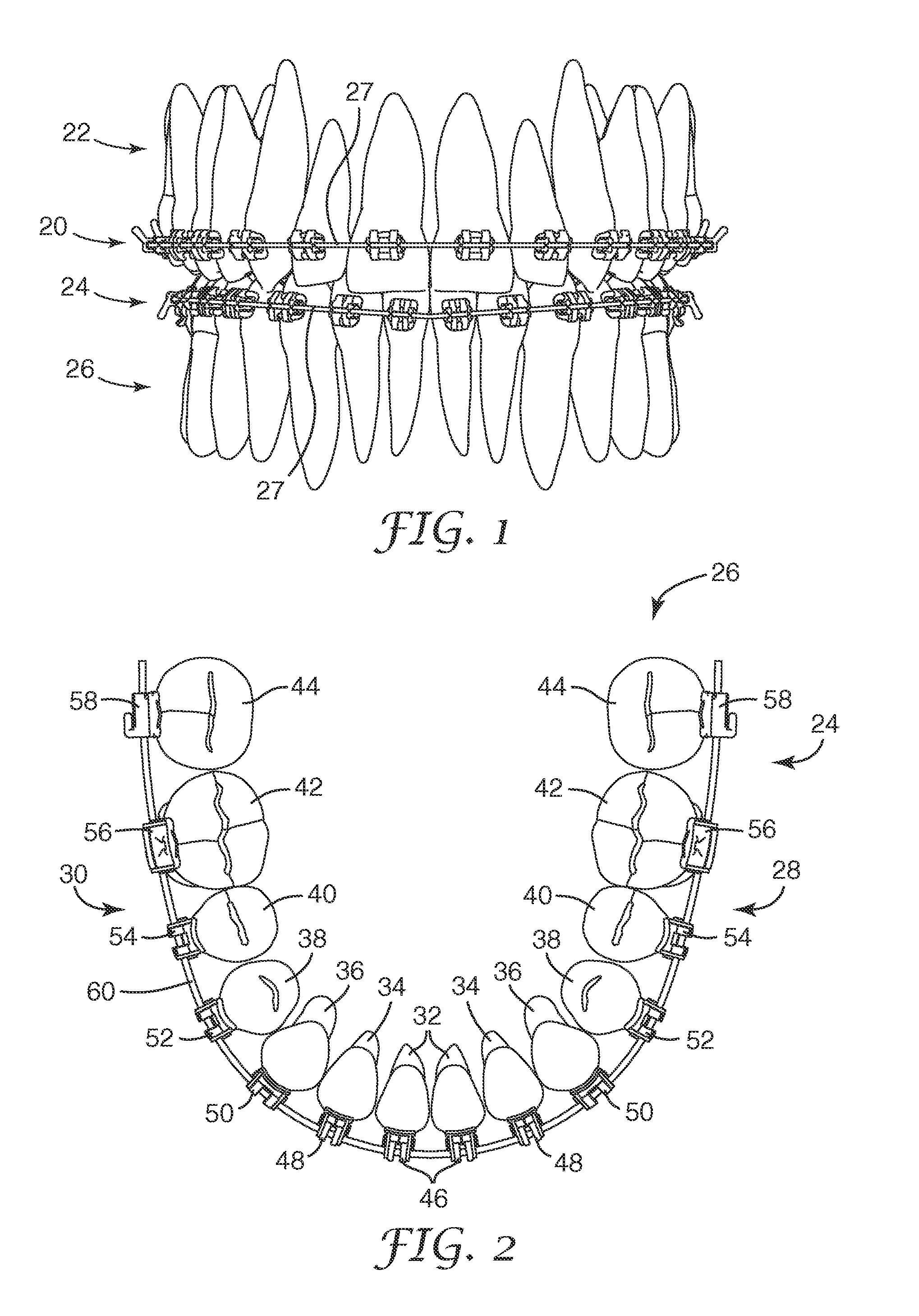 Orthodontic brace with coordinated bracket profiles