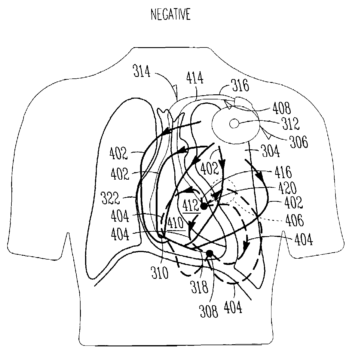 Monitoring fluid in a subject using an electrode configuration providing negative sensitivity regions