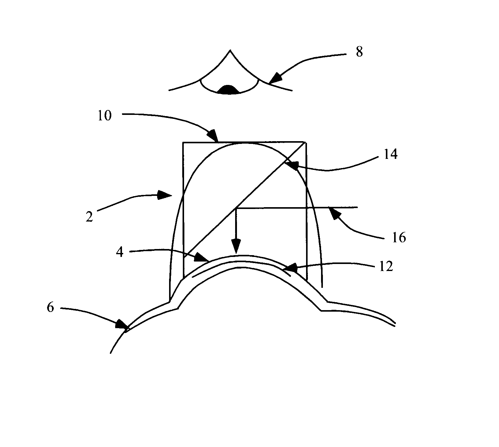 Intrastromal refractive surgery by inducing shape change of the cornea