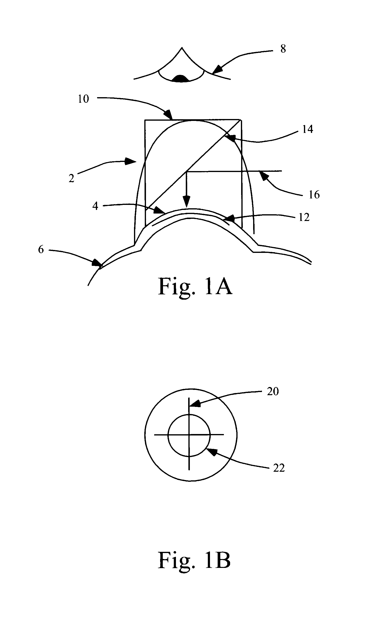 Intrastromal refractive surgery by inducing shape change of the cornea