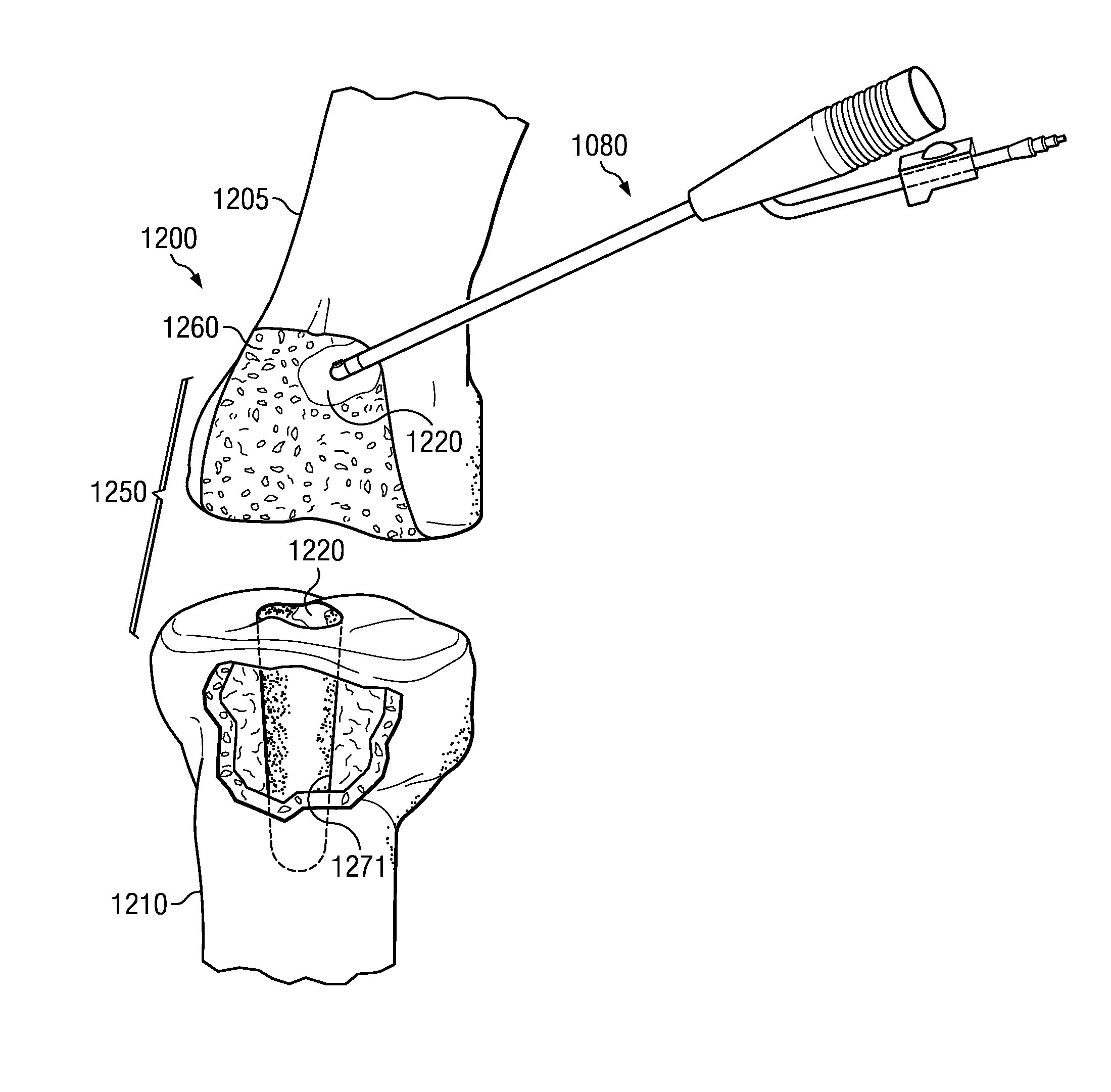 Electrosurgical system and method for treating hard body tissue