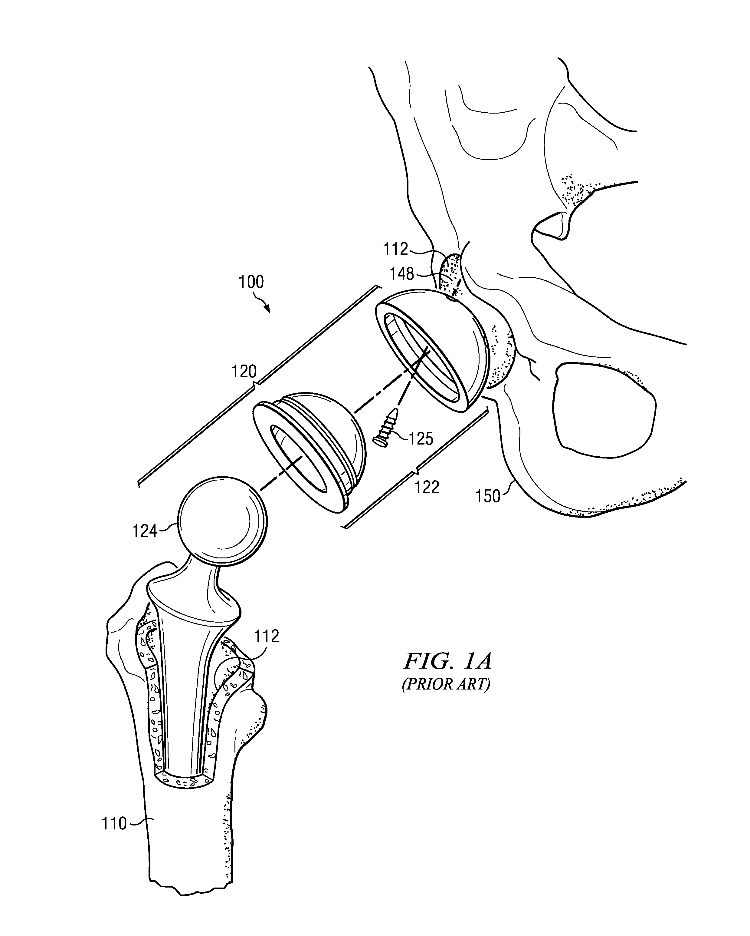 Electrosurgical system and method for treating hard body tissue