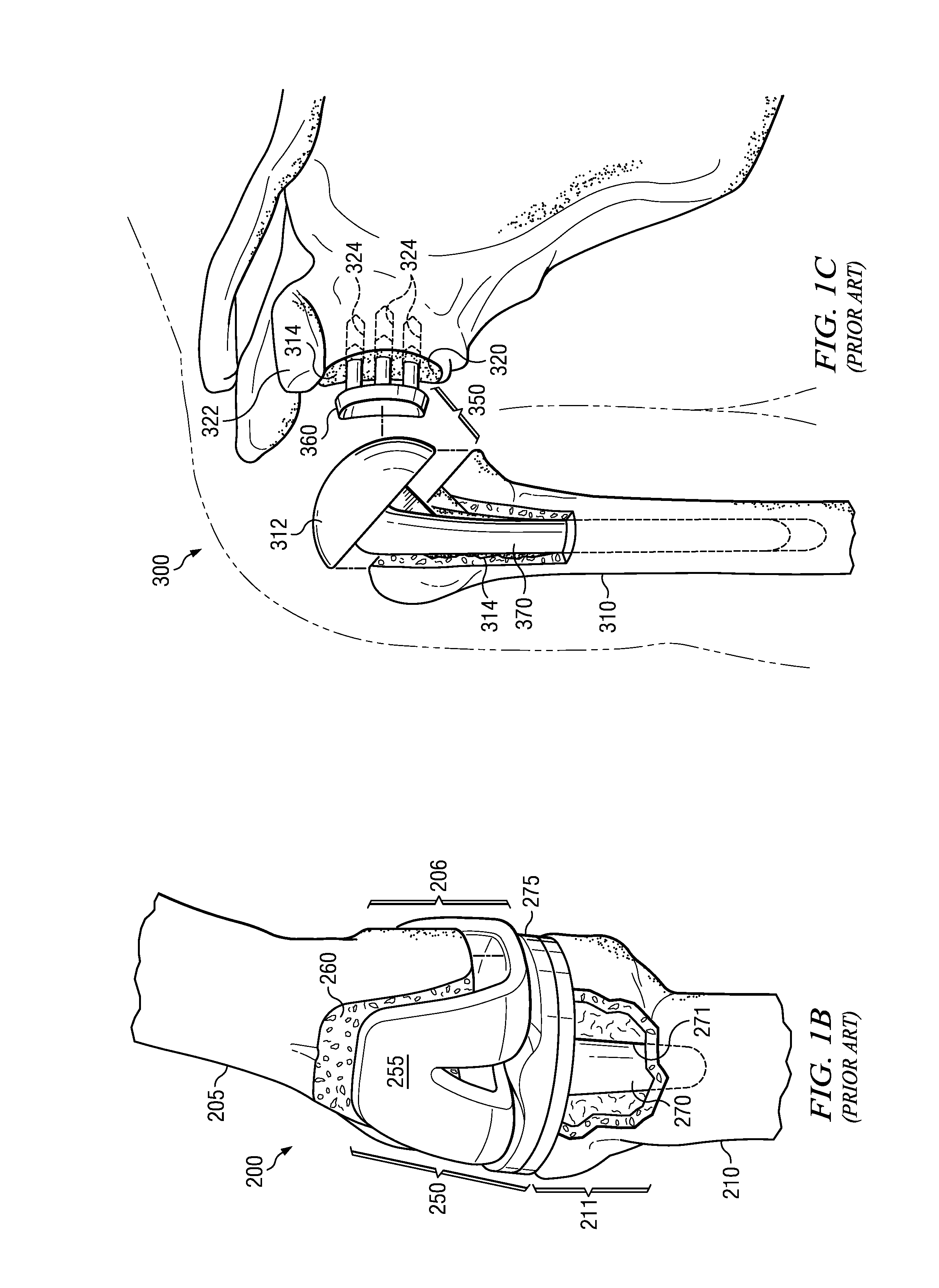 Electrosurgical system and method for treating hard body tissue