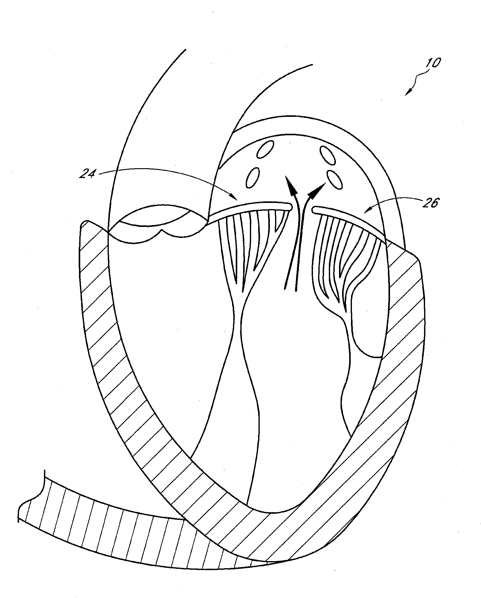 Percutaneous transvalvular intraannular band for mitral valve repair