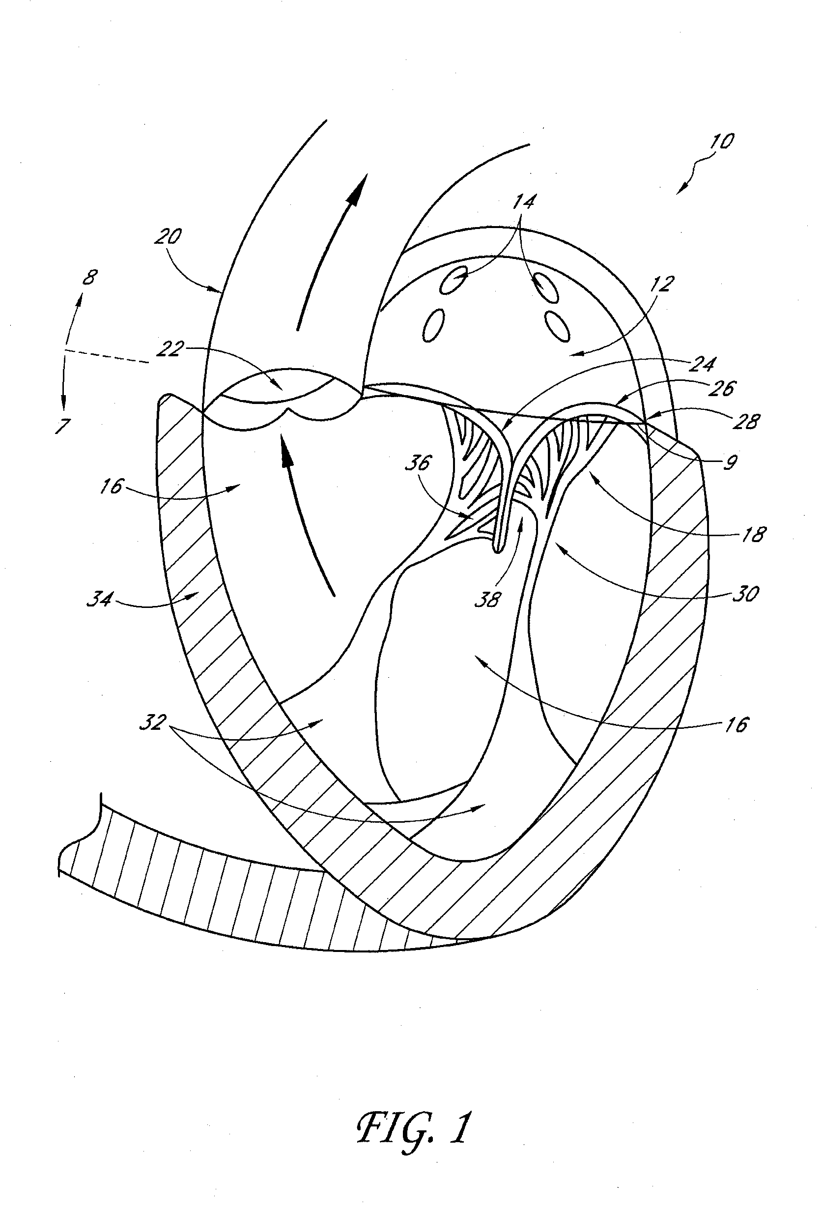 Percutaneous transvalvular intraannular band for mitral valve repair