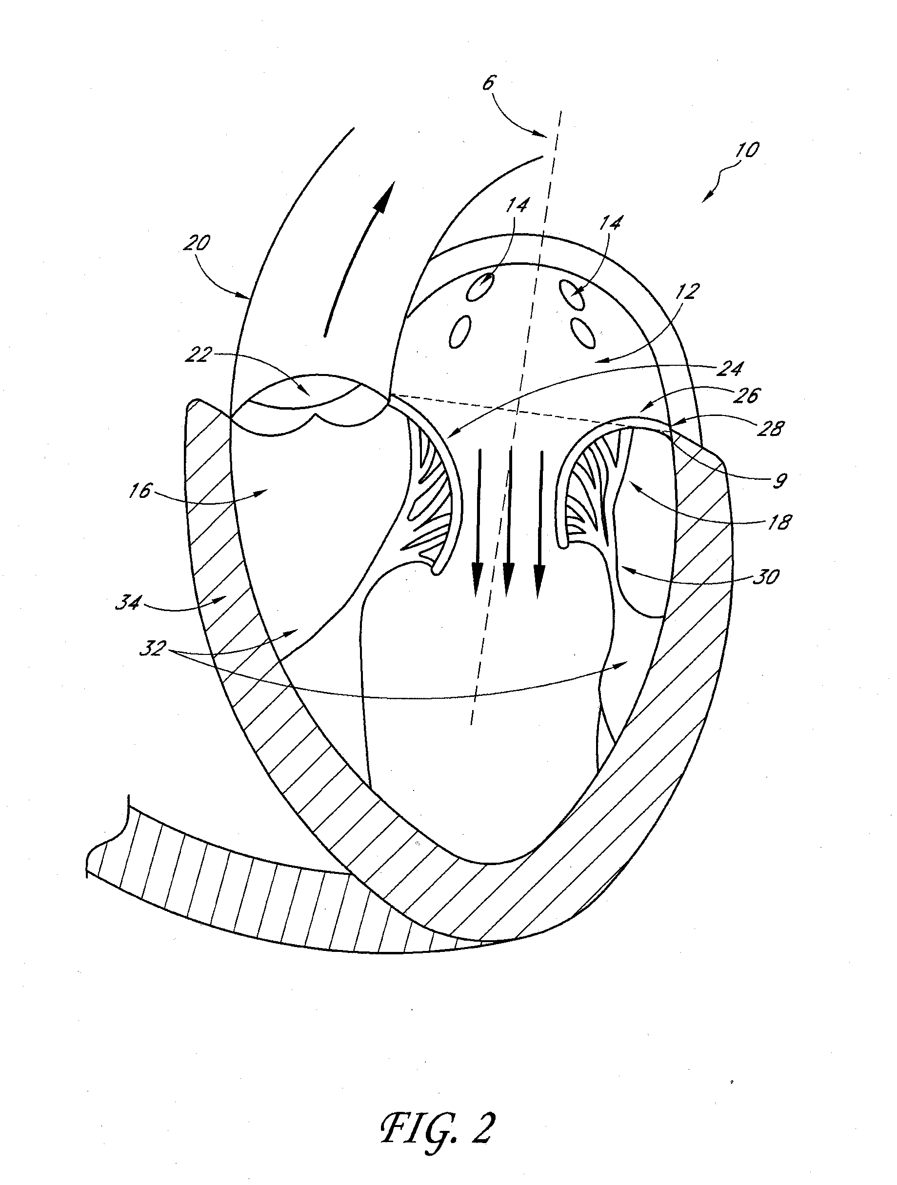 Percutaneous transvalvular intraannular band for mitral valve repair