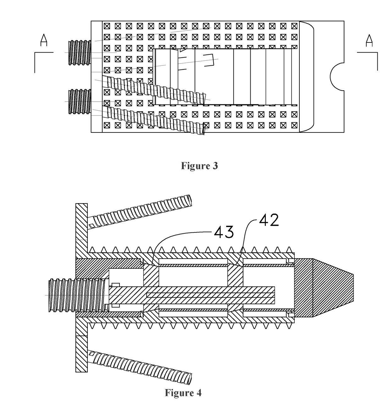 Lumbar Interbody Fusion Cage for Treating Lumbar Spondylolisthesis via Lateral Approach