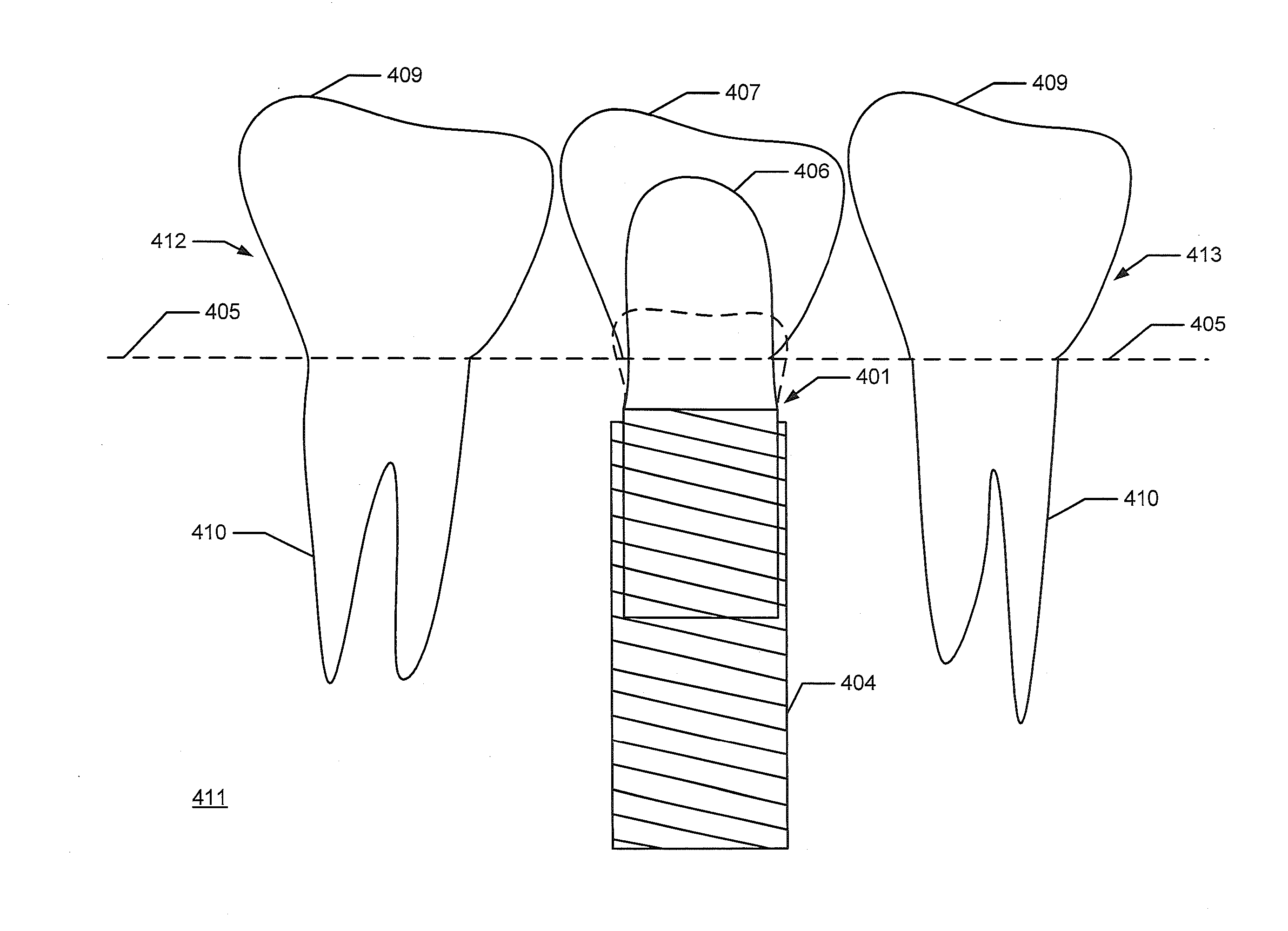 Virtually designing a customized healing abutment