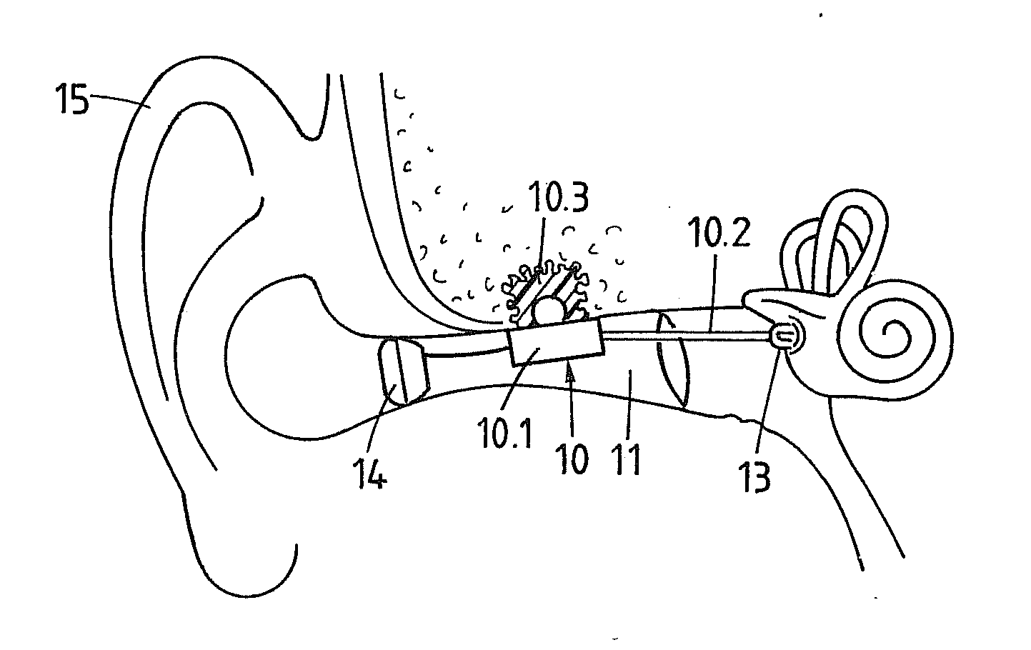 Method of anchoring an acoustic element in a bone of the craniomaxillofacial region and acoustic element