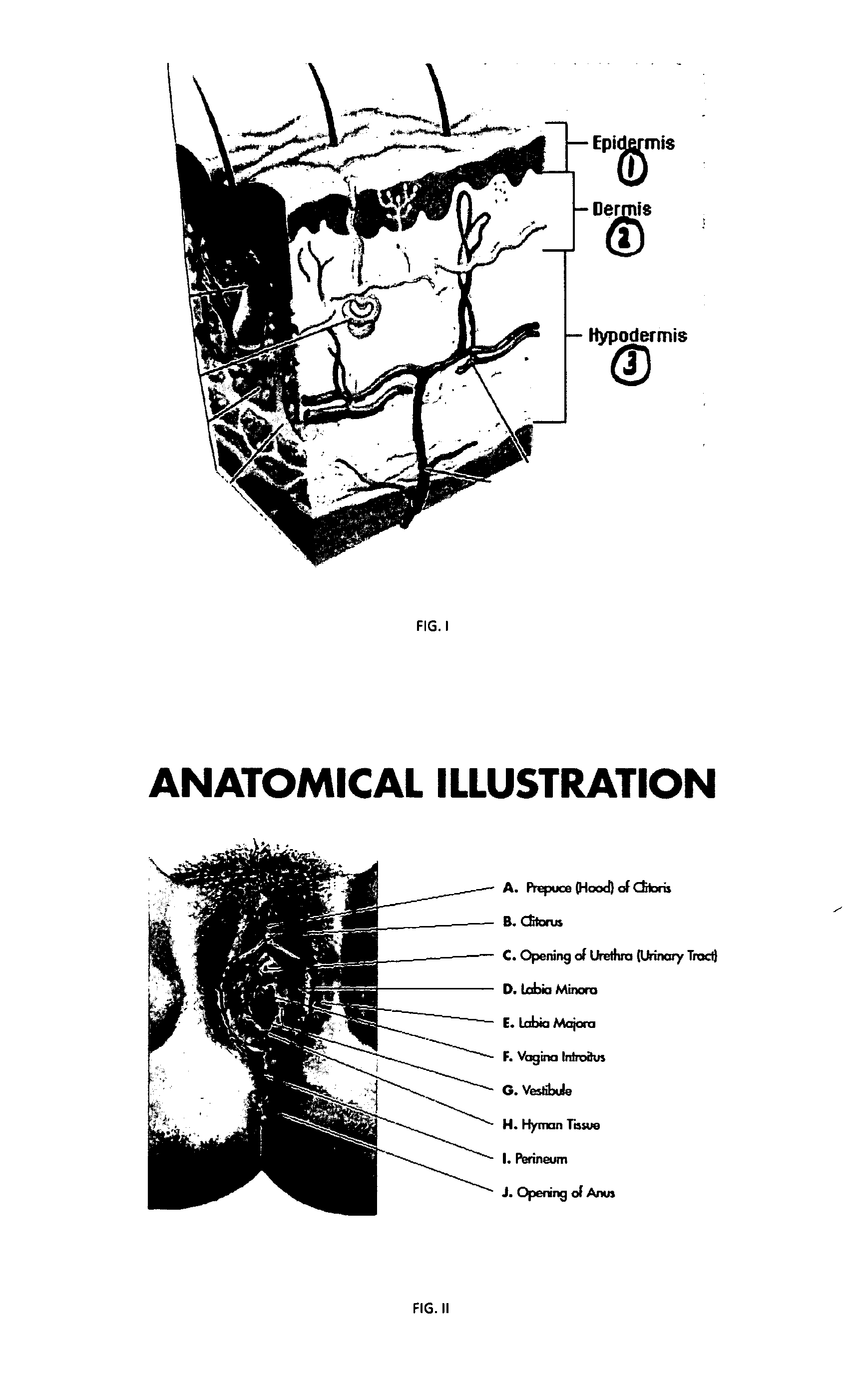 Method for correction of female urinary incontinence and skin reduction