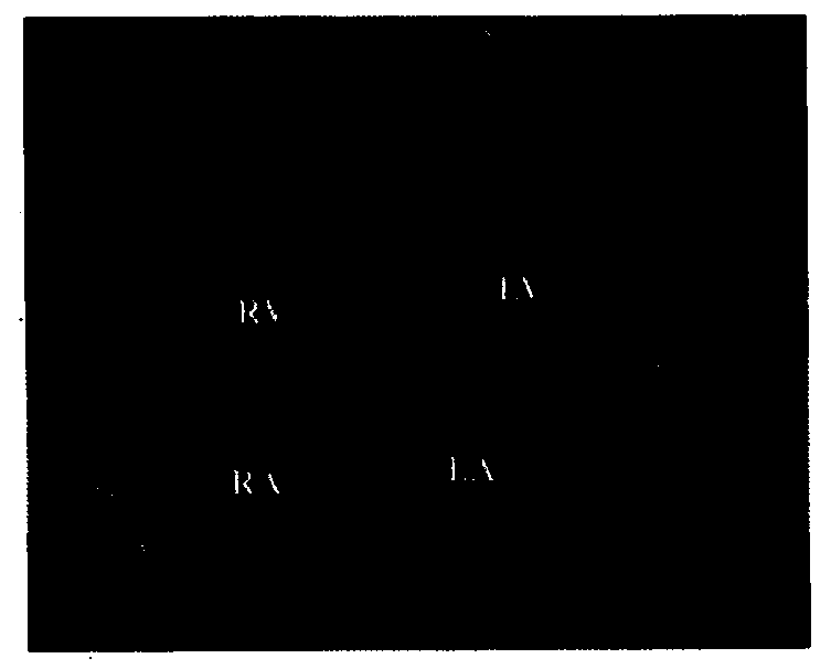 A carbon dioxide microbubble ultrasound contrast agent