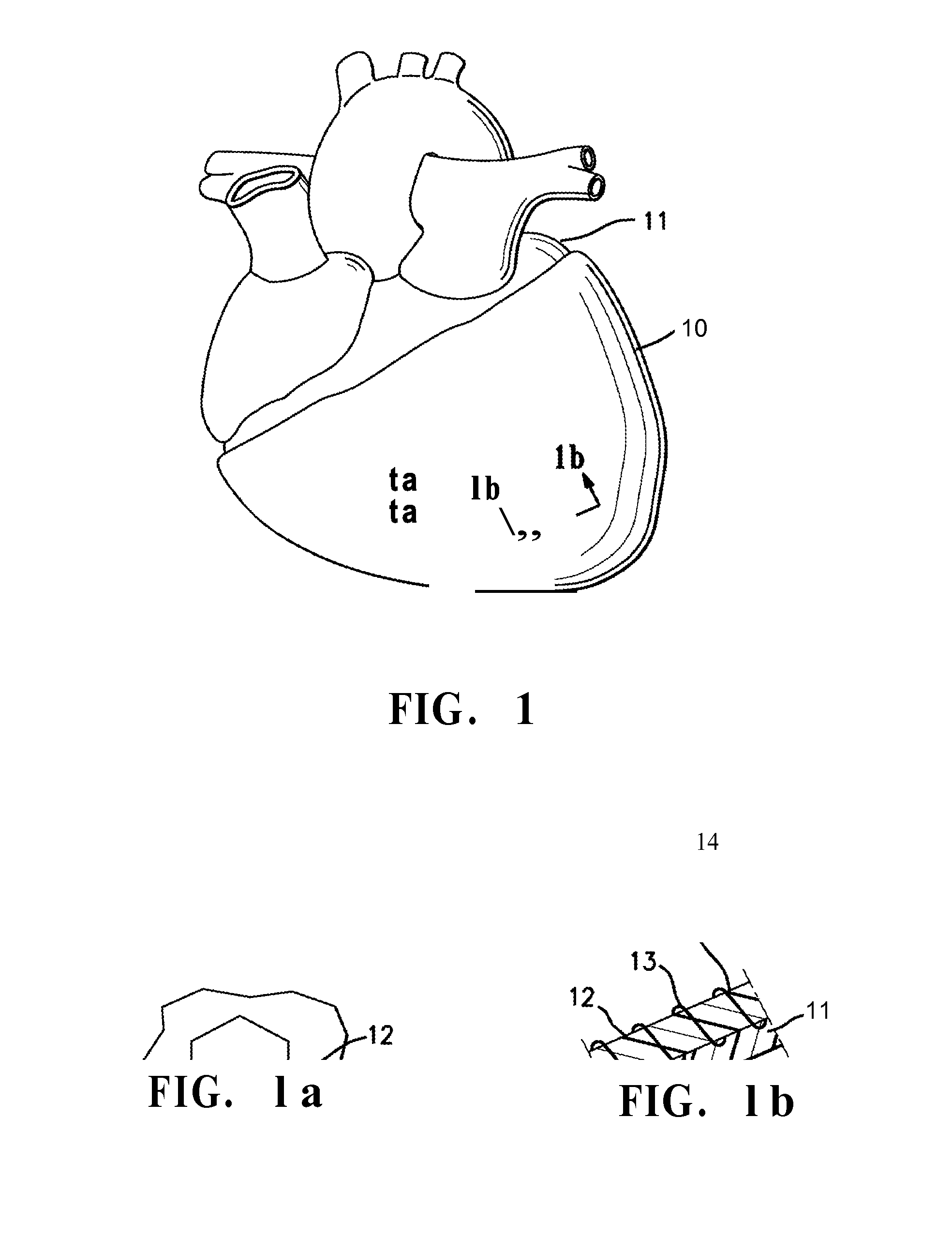 Intelligent Nanomagnetic Cardiac Assist Device for a Failing Heart