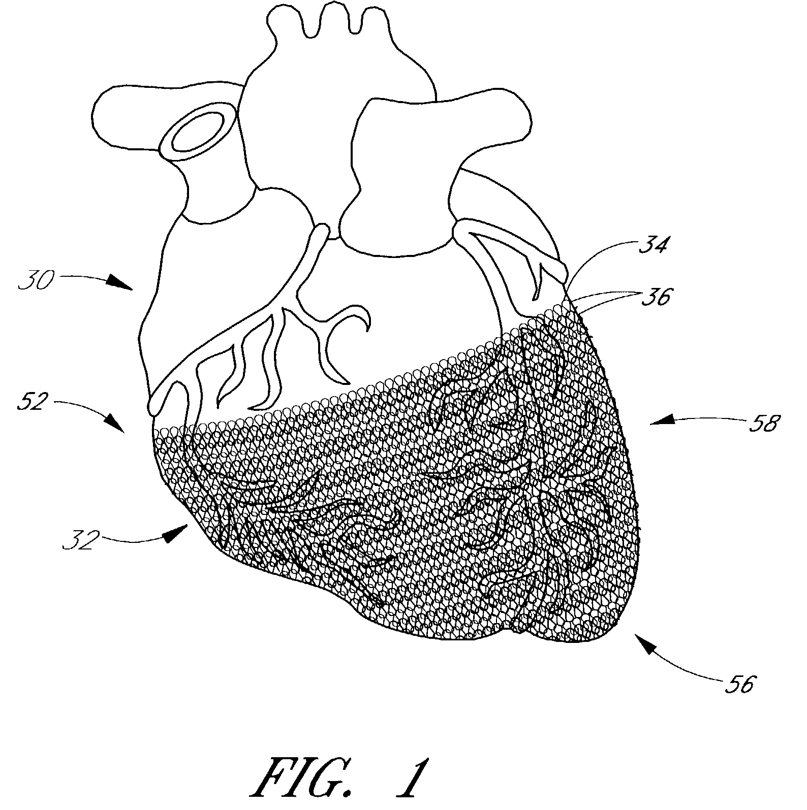 Heart failure treatment device and method