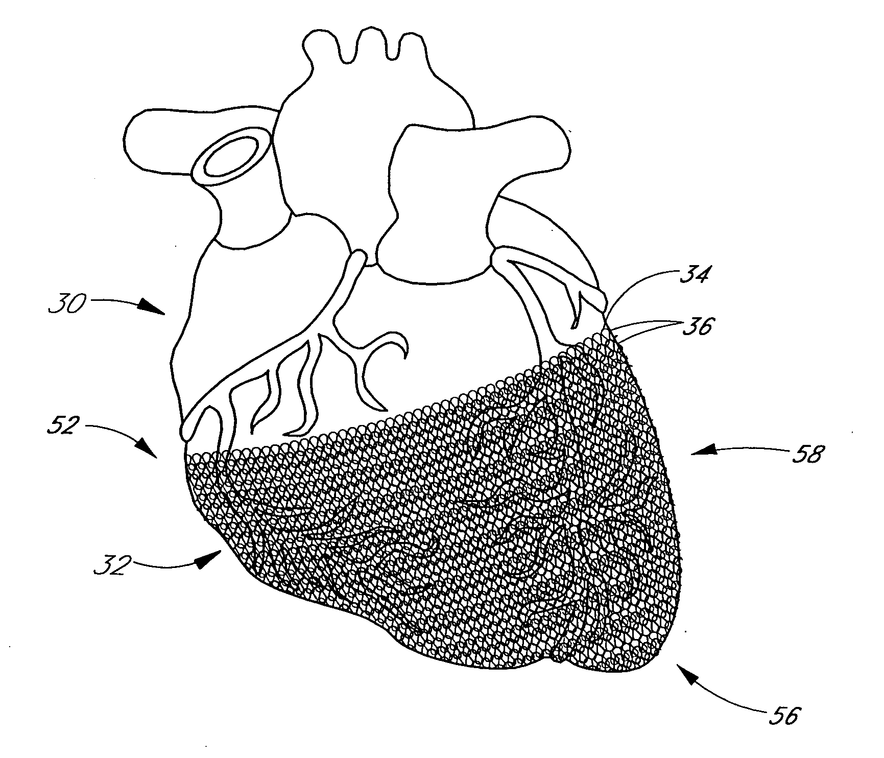 Heart failure treatment device and method