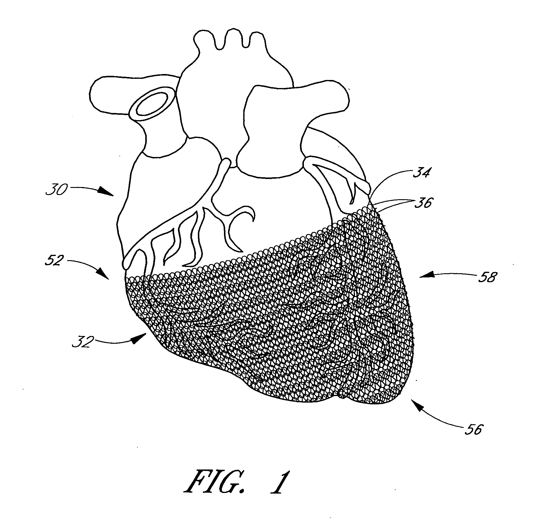 Heart failure treatment device and method