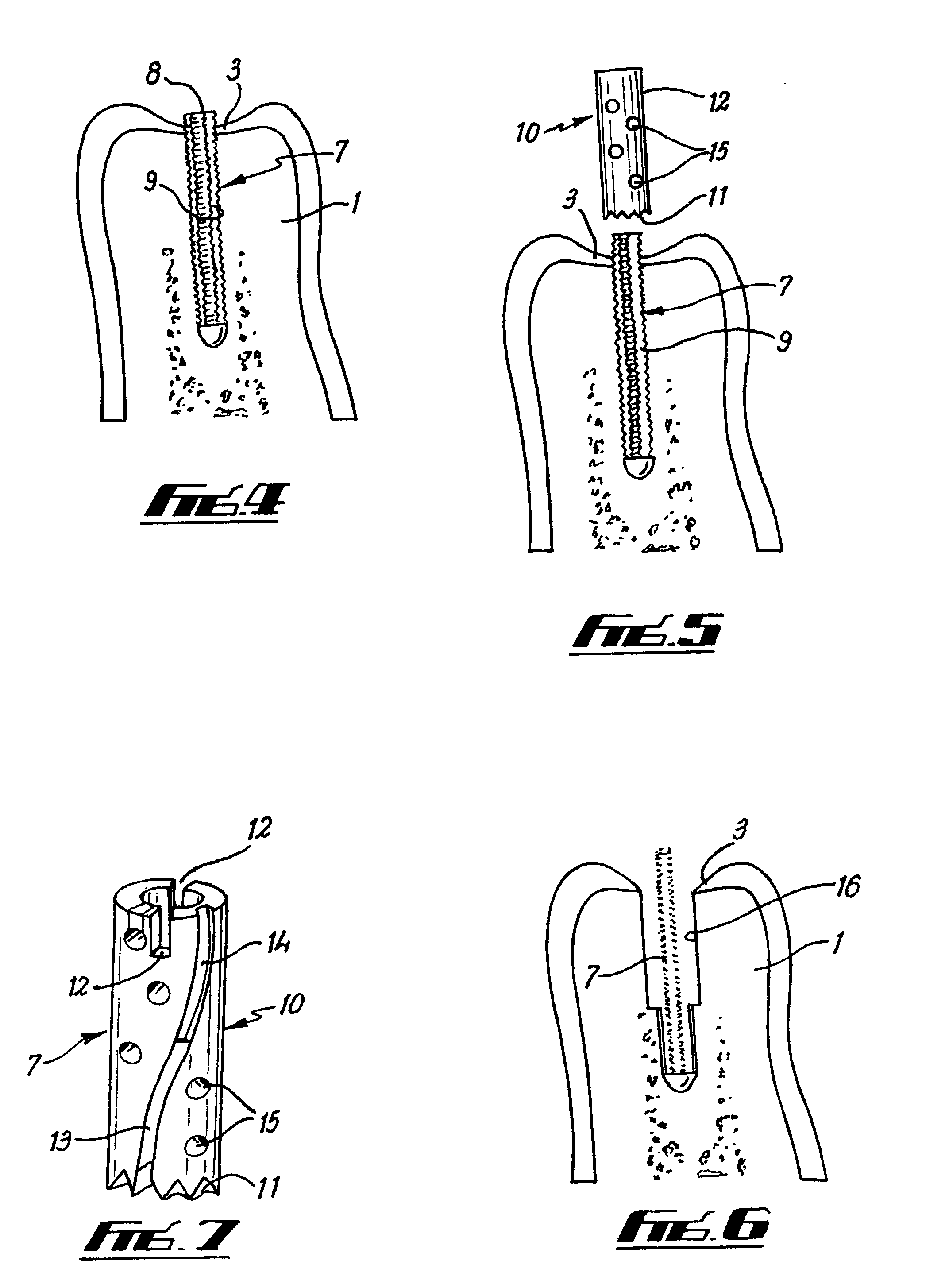 Guide post for trephine