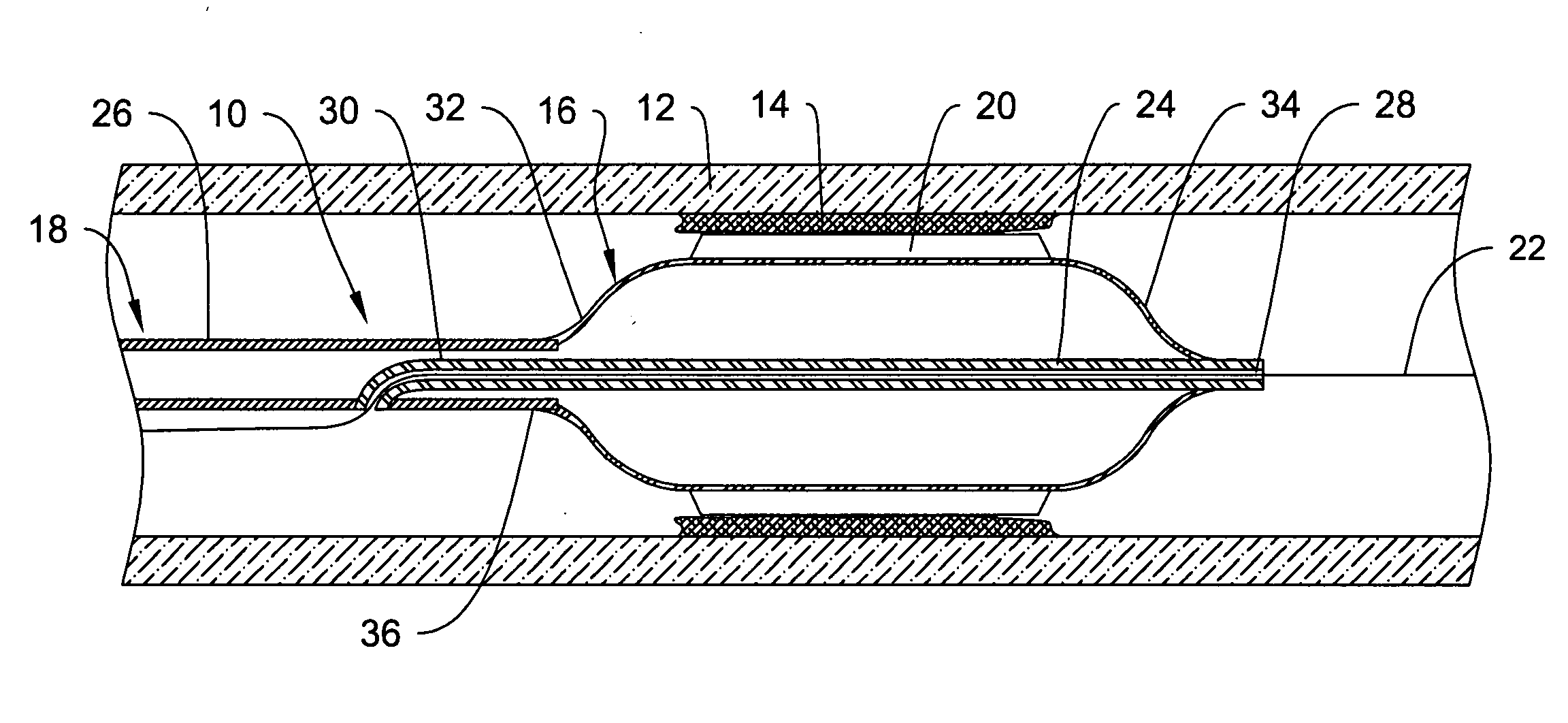 Cutting balloon catheter having flexible atherotomes